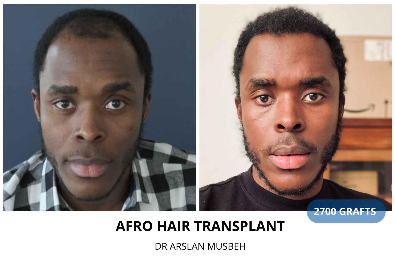 AFRO Hair Transplant result, 2700 grafts by Dr. Arslan Musbeh