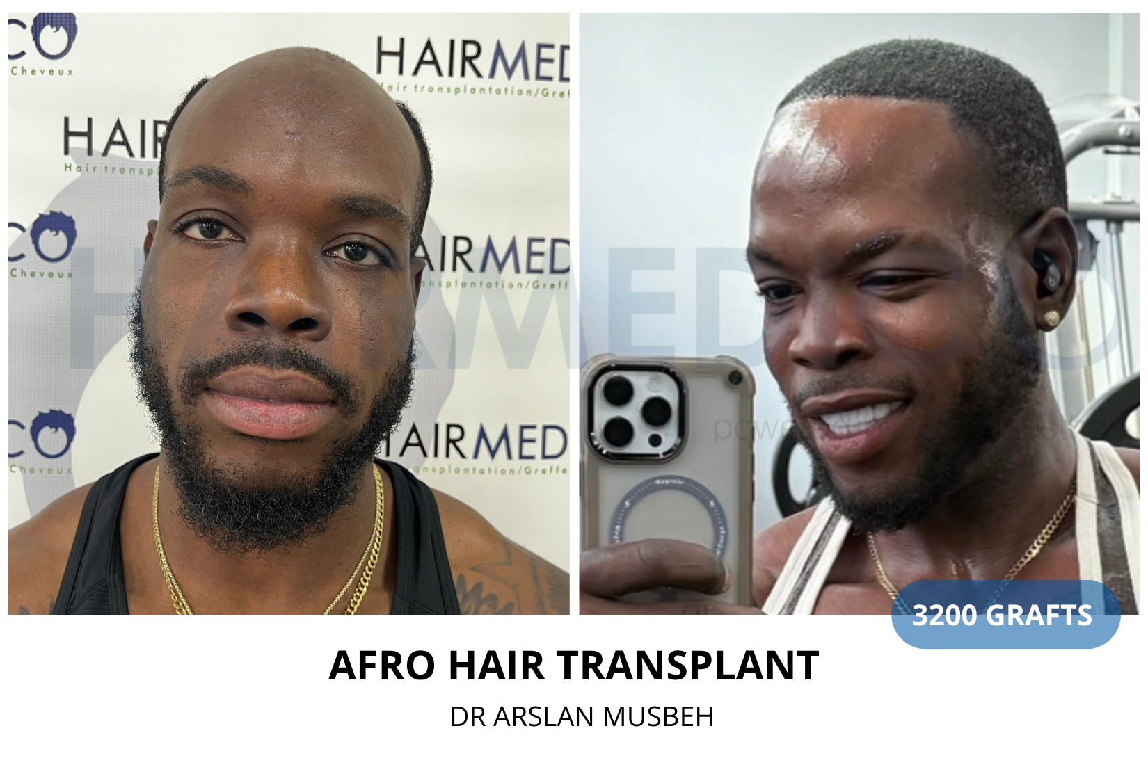 AFRO Hair Transplant result, 3200 grafts by Dr. Arslan Musbeh