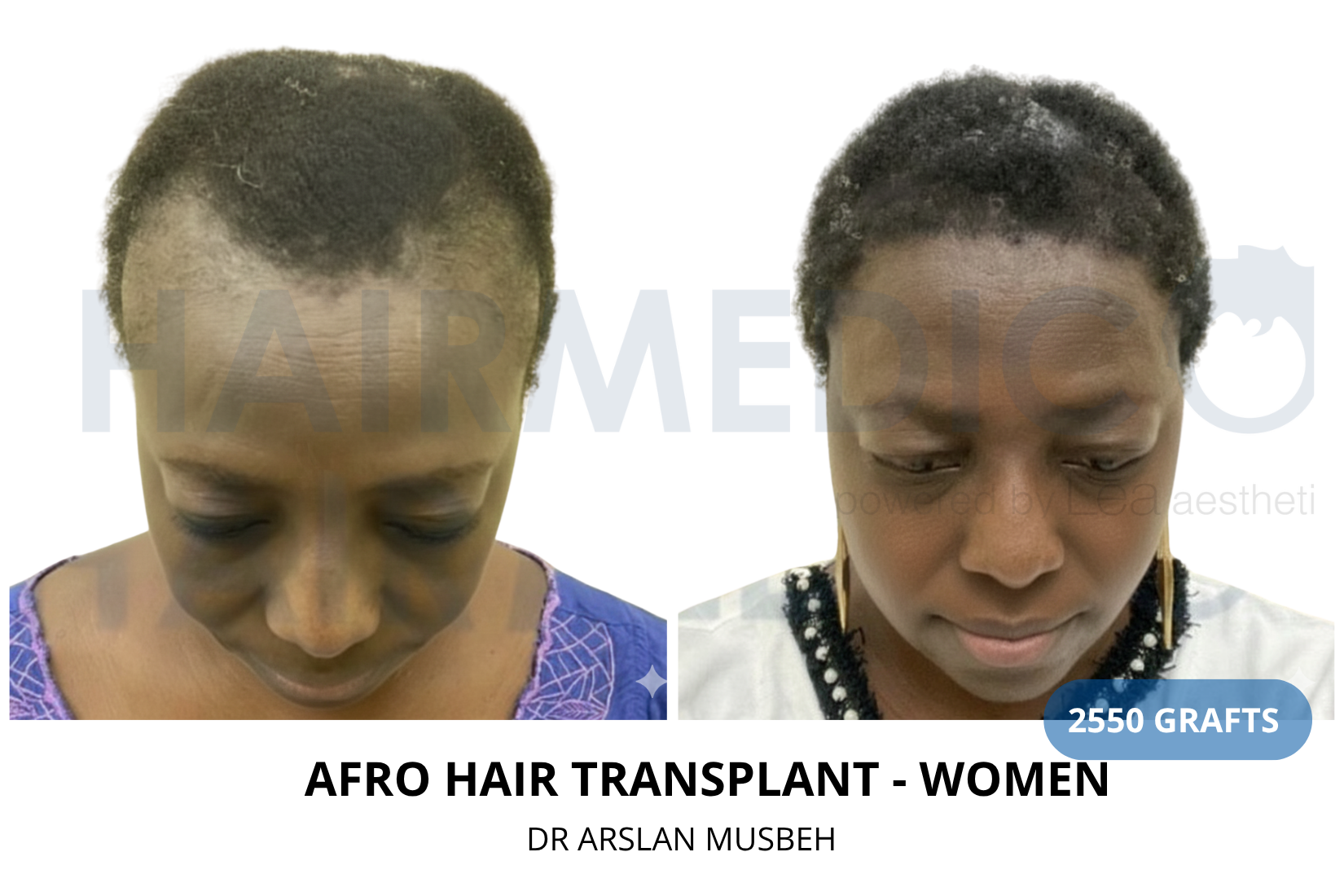 AFRO Hair Transplant result, 2550 grafts by Dr. Arslan Musbeh