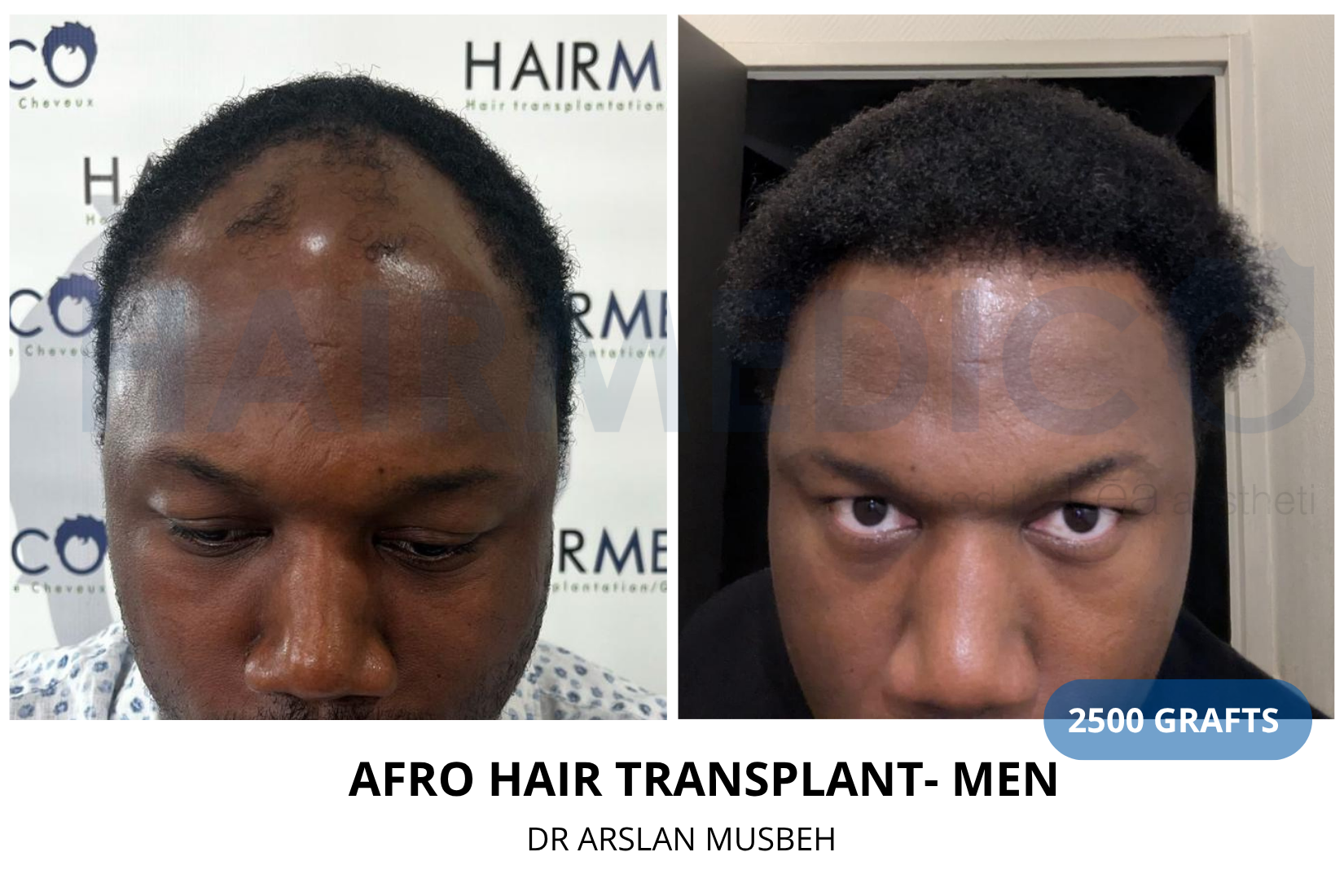 AFRO Hair Transplant result, 2500 grafts by Dr. Arslan Musbeh