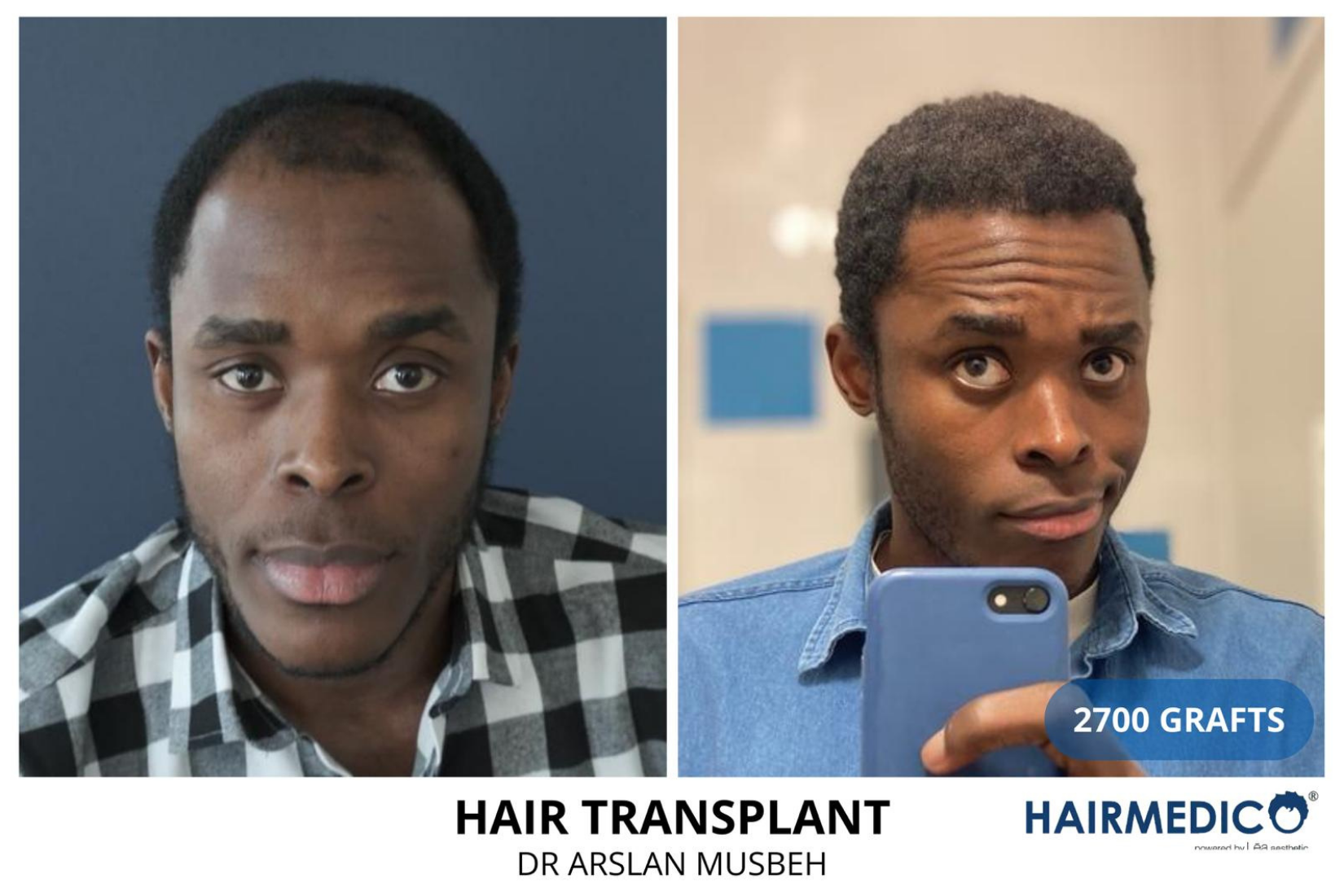 AFRO Hair Transplant result, 2700 grafts by Dr. Arslan Musbeh