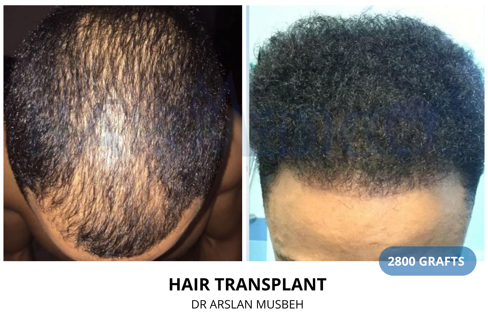 AFRO Hair Transplant result, 2800 grafts by Dr. Arslan Musbeh