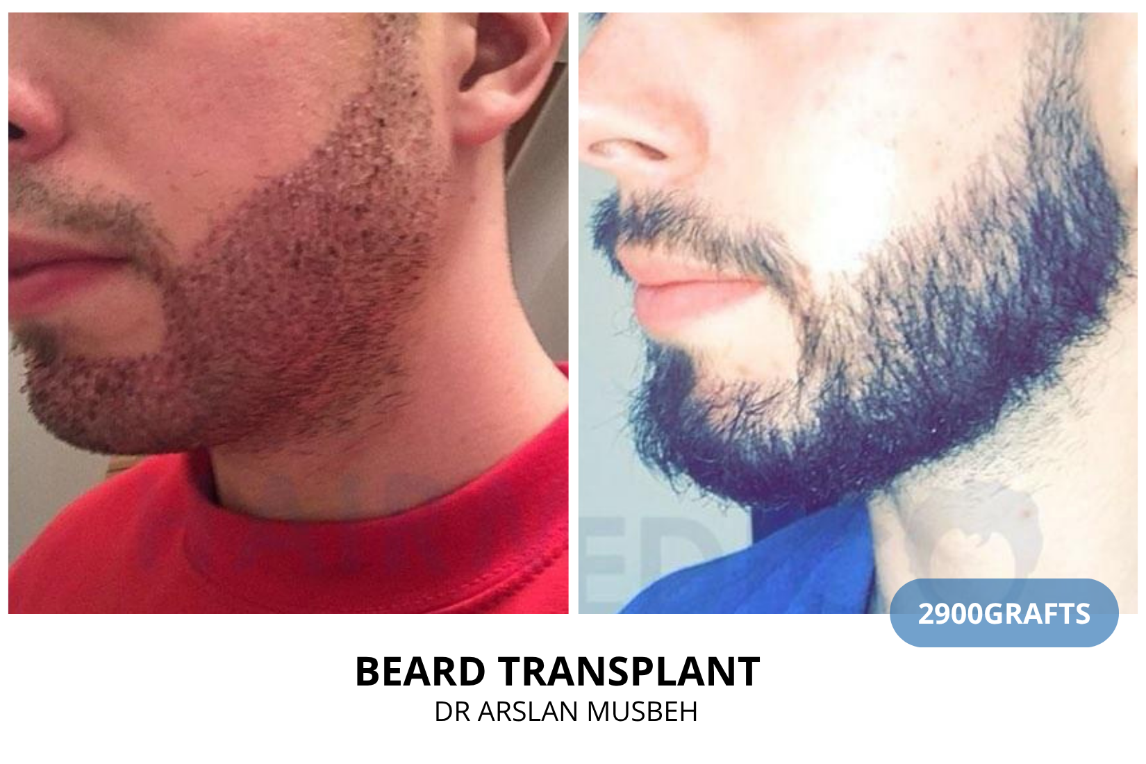 Beard Transplant result, 2900 grafts by Dr. Arslan Musbeh