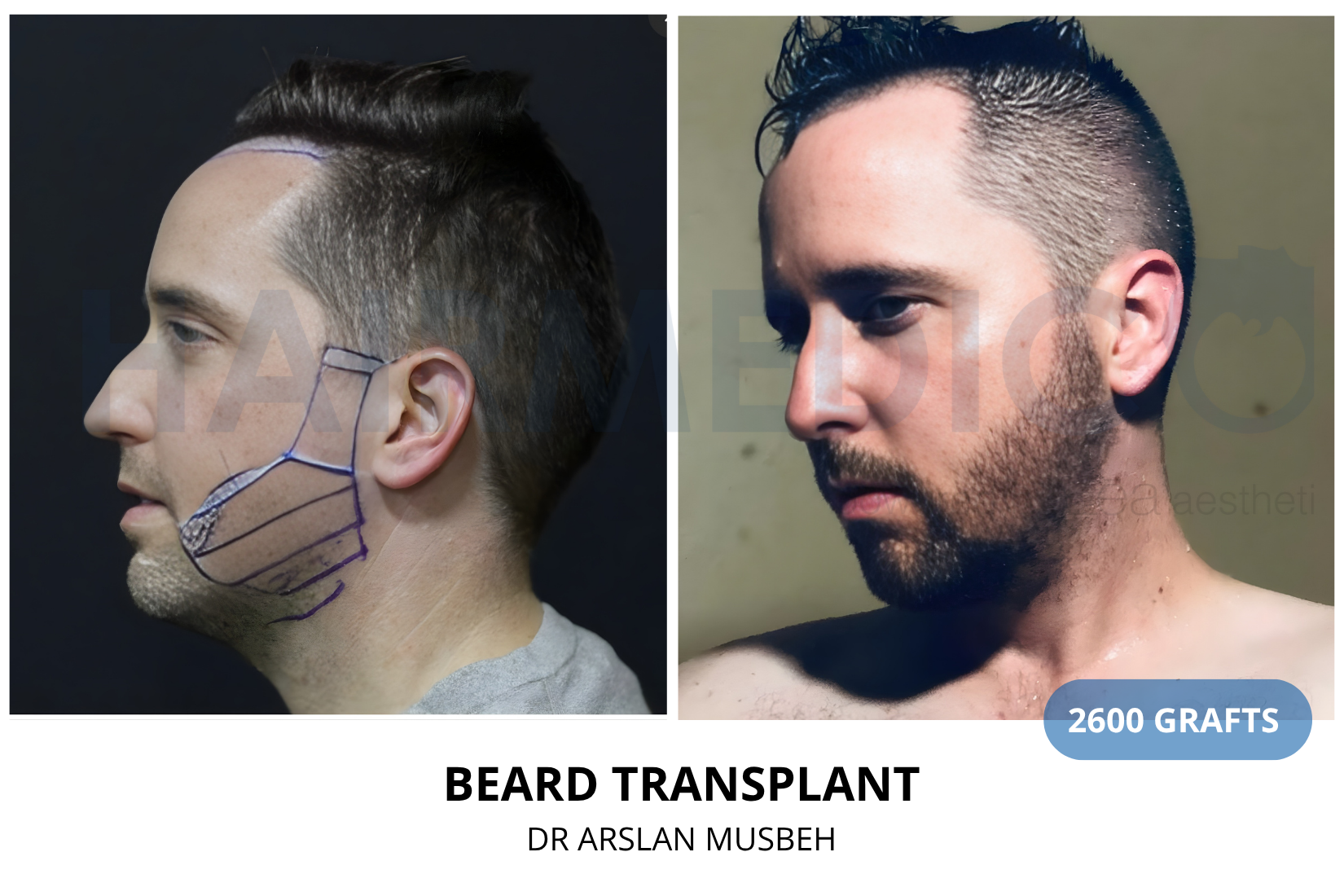 Beard Transplant result, 2600 grafts by Dr. Arslan Musbeh