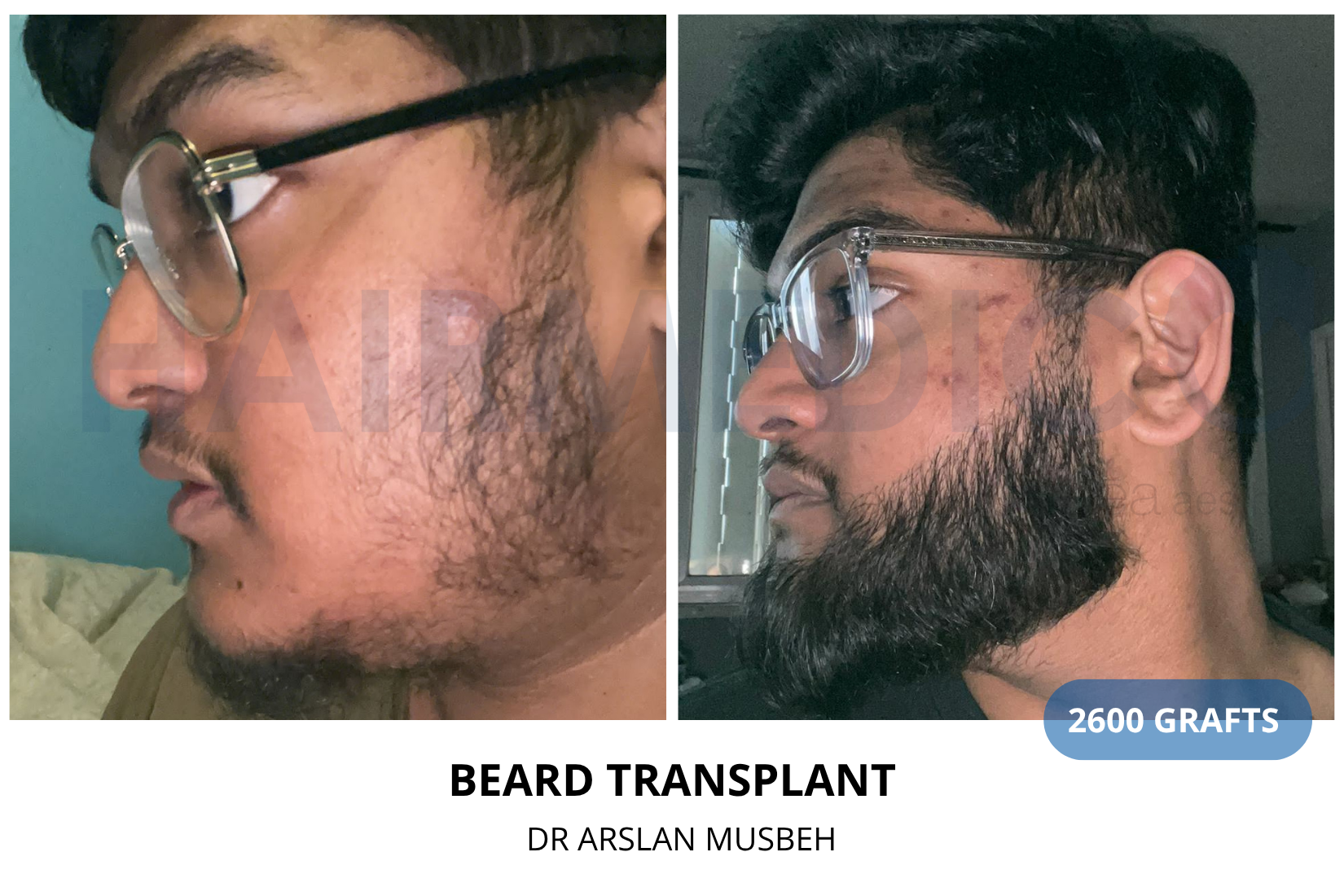 Beard Transplant result, 2600 grafts by Dr. Arslan Musbeh