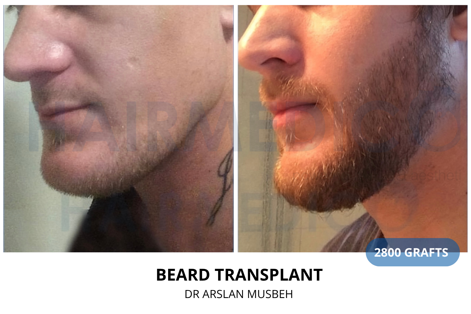 Beard Transplant result, 2800 grafts by Dr. Arslan Musbeh