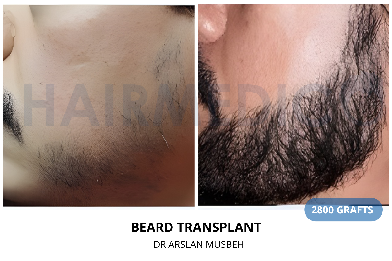 Beard Transplant result, 2800 grafts by Dr. Arslan Musbeh