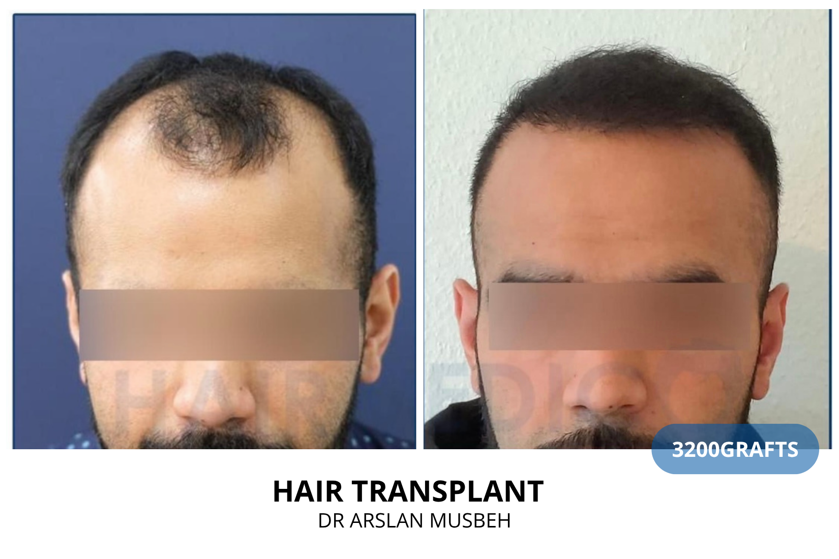 Hair Transplant result, 3200 grafts by Dr. Arslan Musbeh
