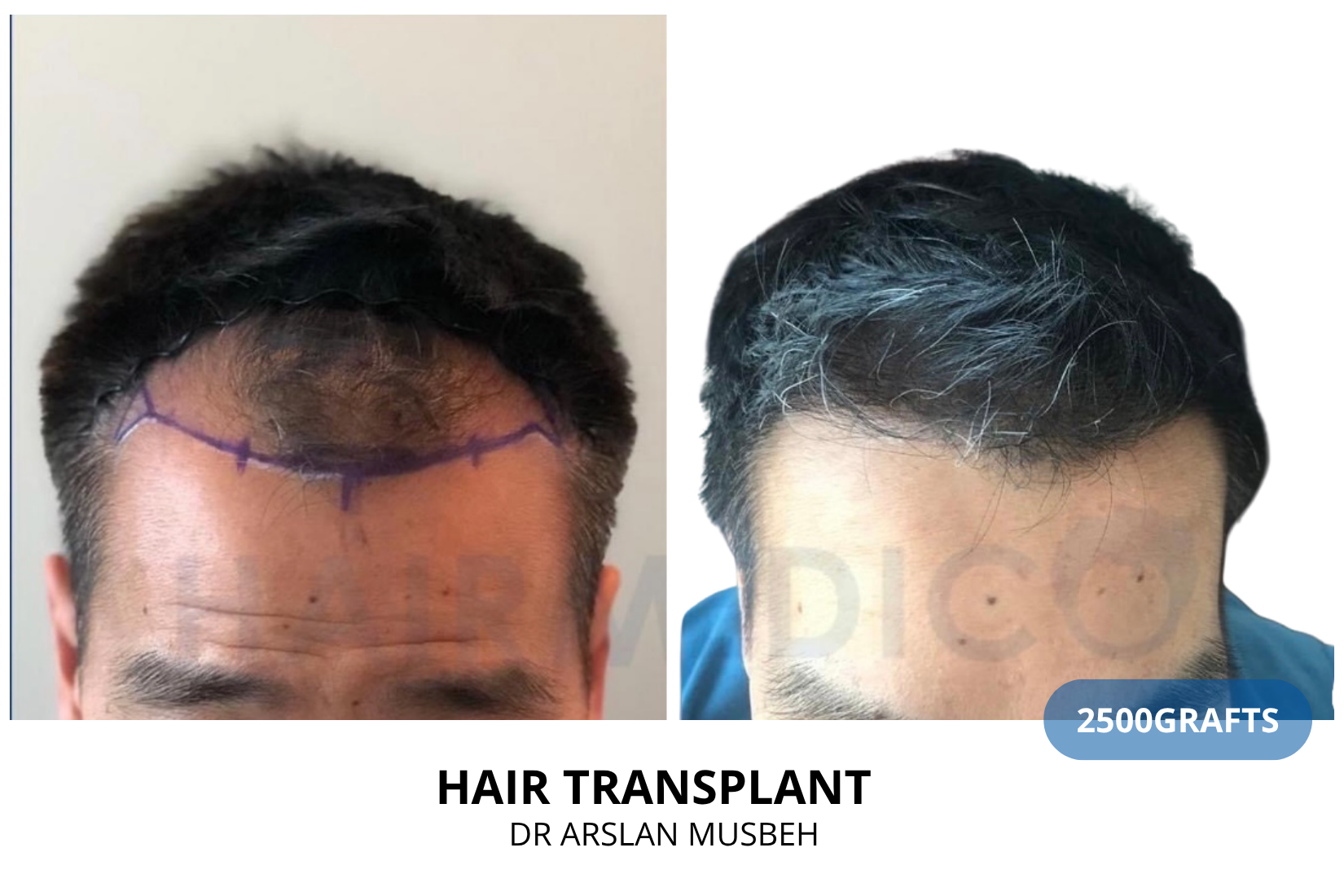 Hair Transplant result, 2500 grafts by Dr. Arslan Musbeh