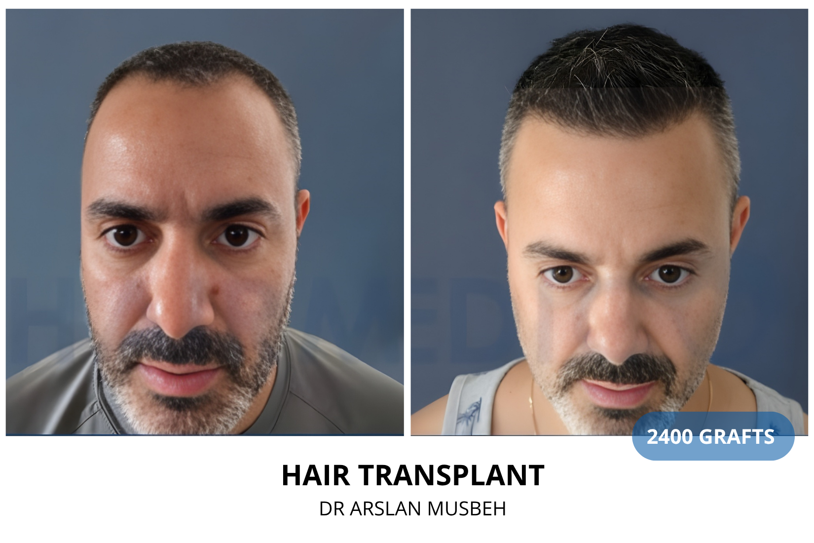 Hair Transplant result, 2400 grafts by Dr. Arslan Musbeh