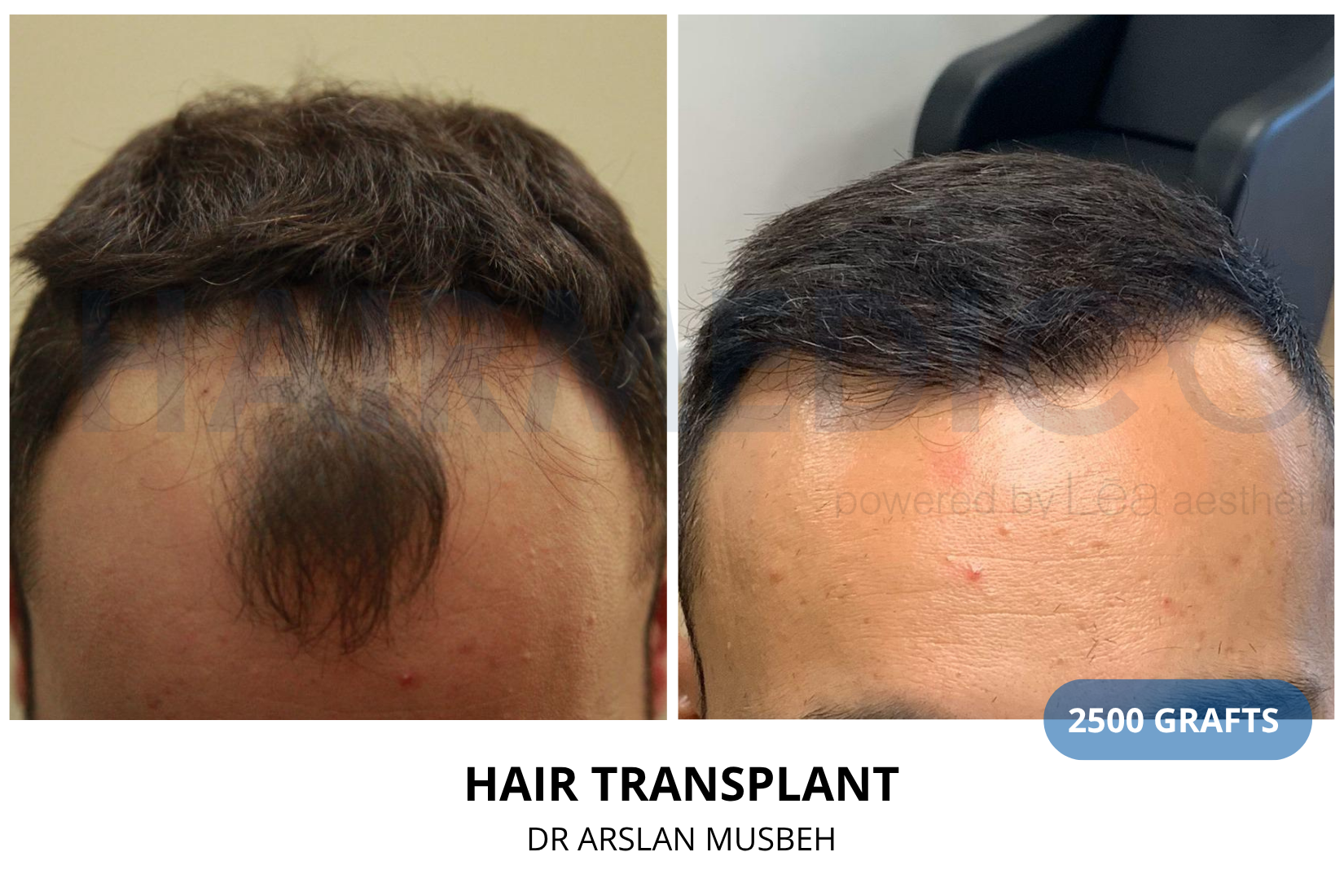 Hair Transplant result, 2500 grafts by Dr. Arslan Musbeh