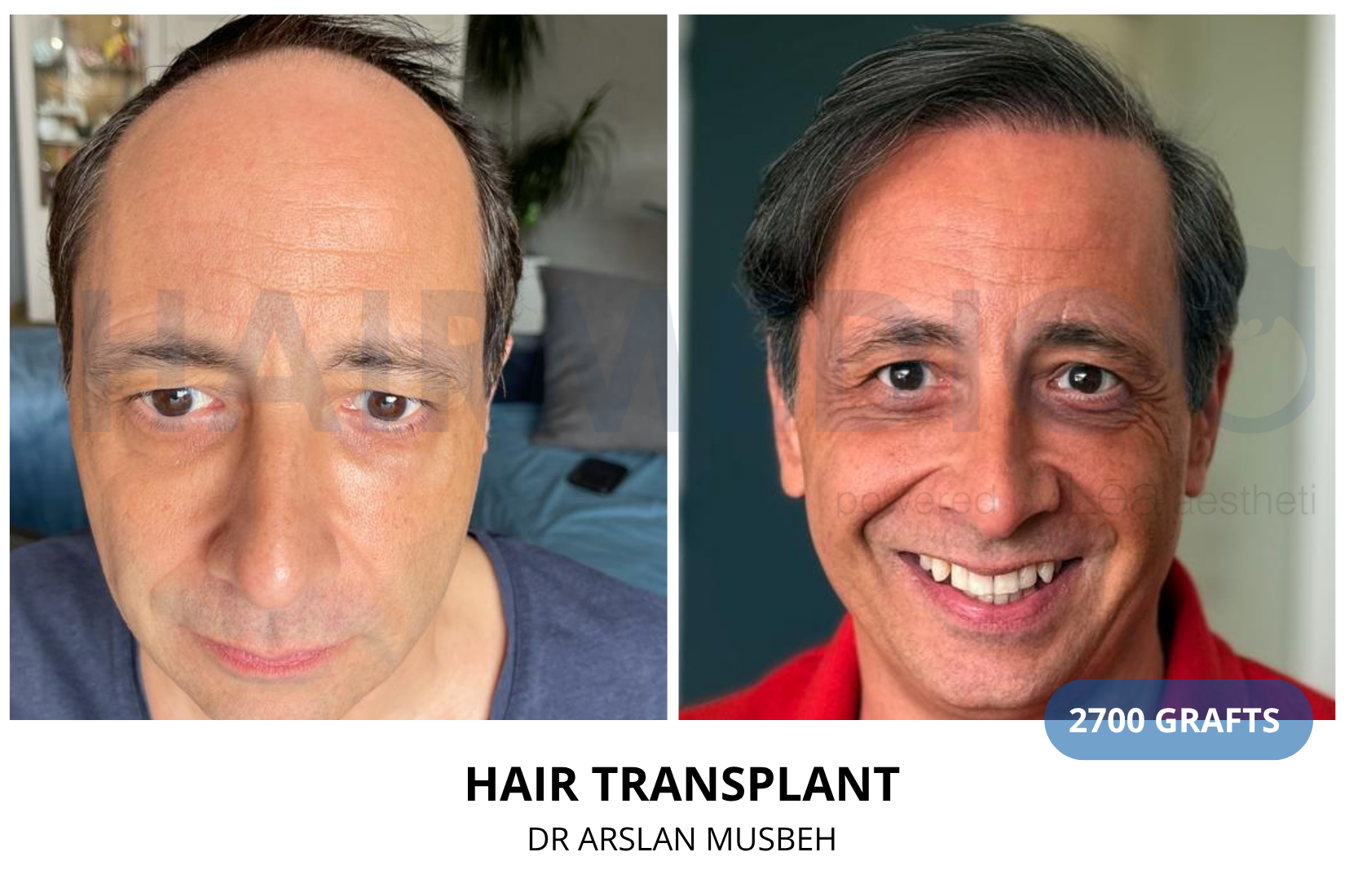 Hair Transplant result, 2700 grafts by Dr. Arslan Musbeh