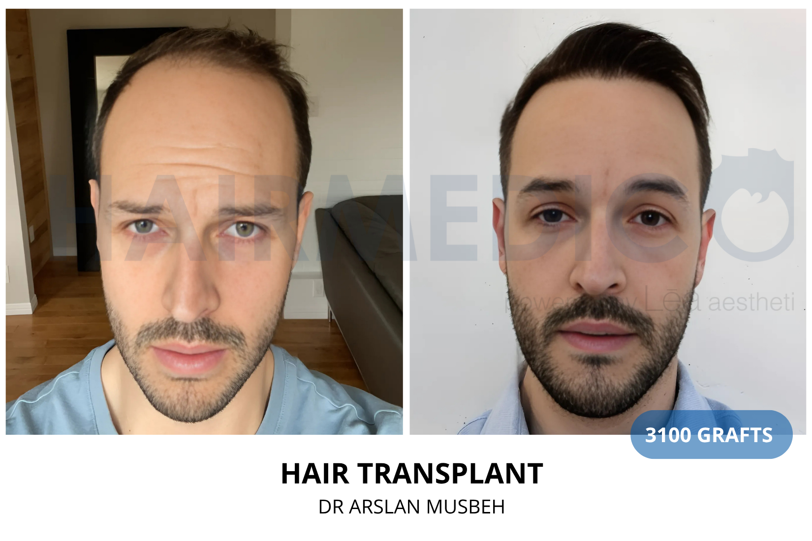 Hair Transplant result, 3100 grafts by Dr. Arslan Musbeh