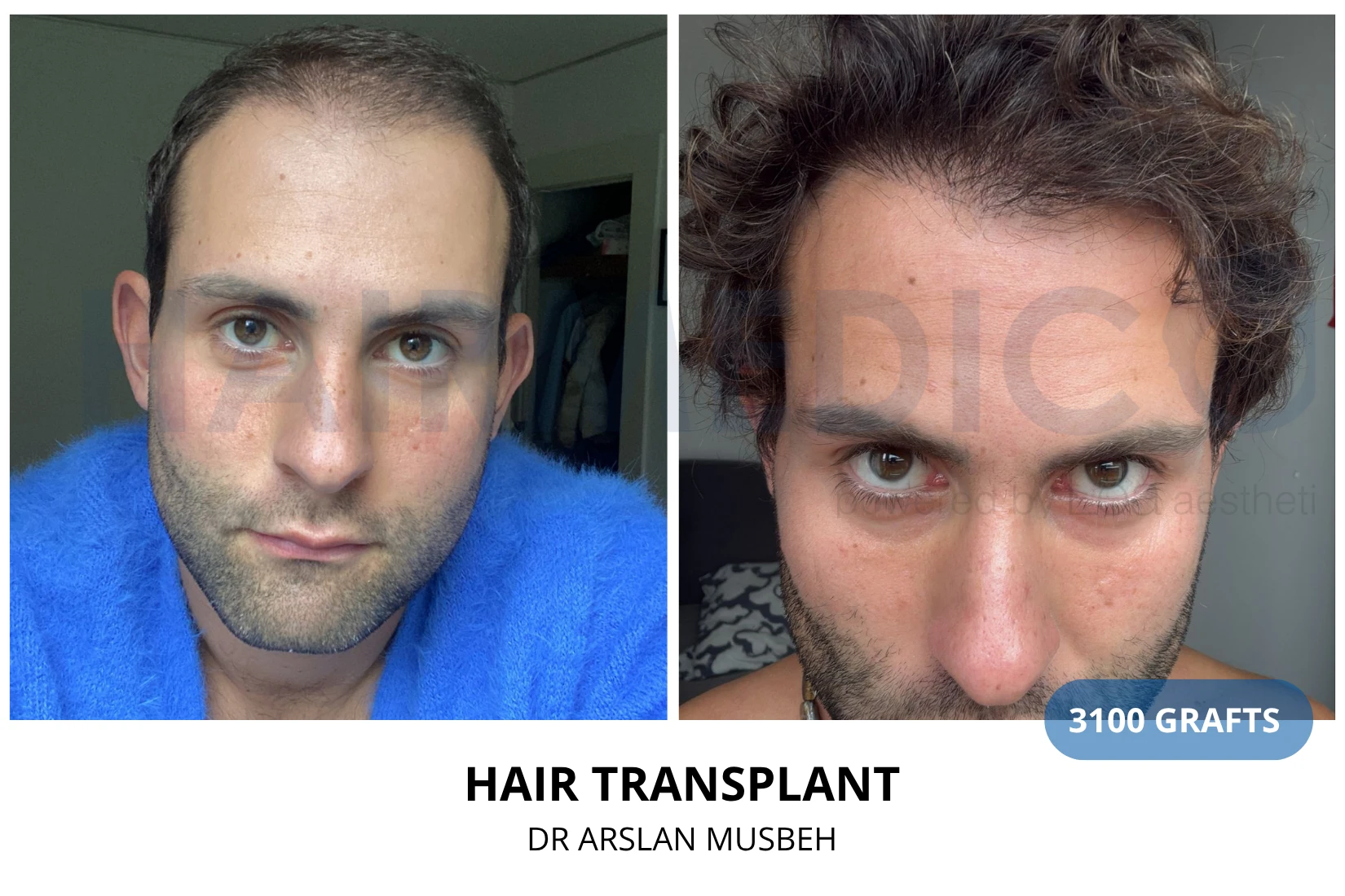 Hair Transplant result, 3100 grafts by Dr. Arslan Musbeh