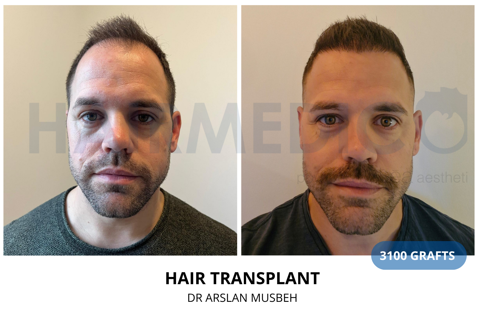 Hair Transplant result, 3100 grafts by Dr. Arslan Musbeh