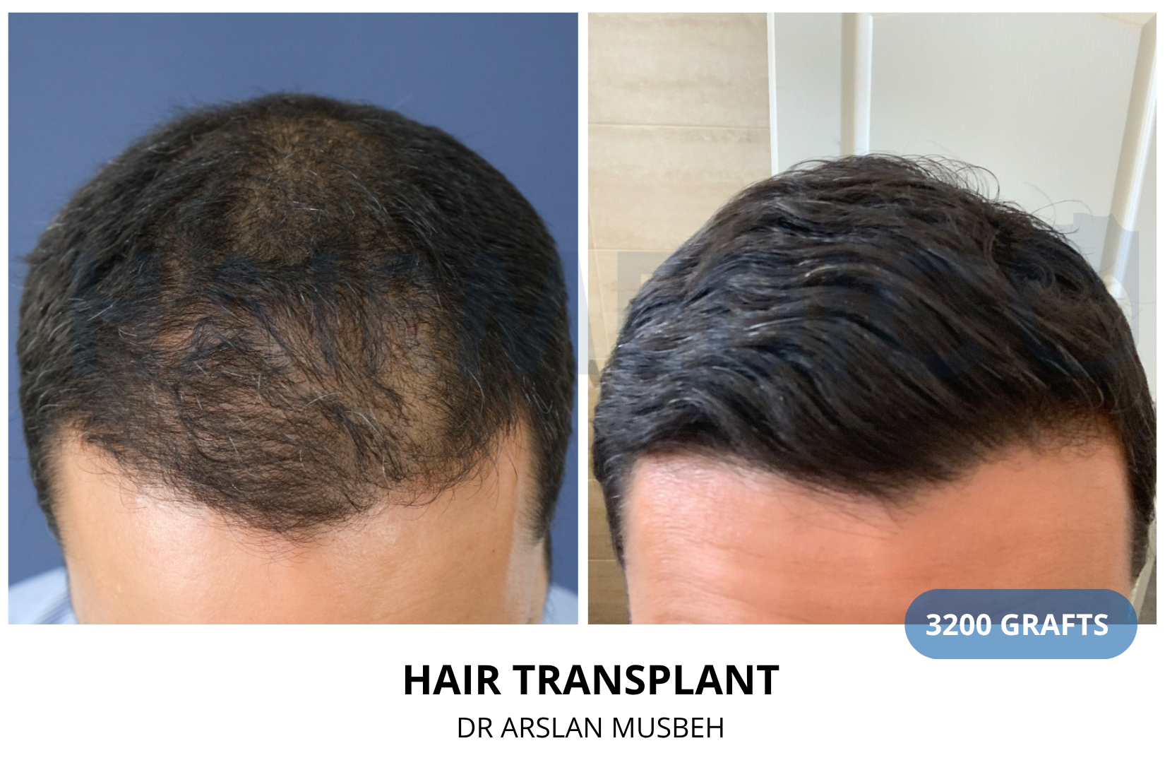 Hair Transplant result, 3200 grafts by Dr. Arslan Musbeh