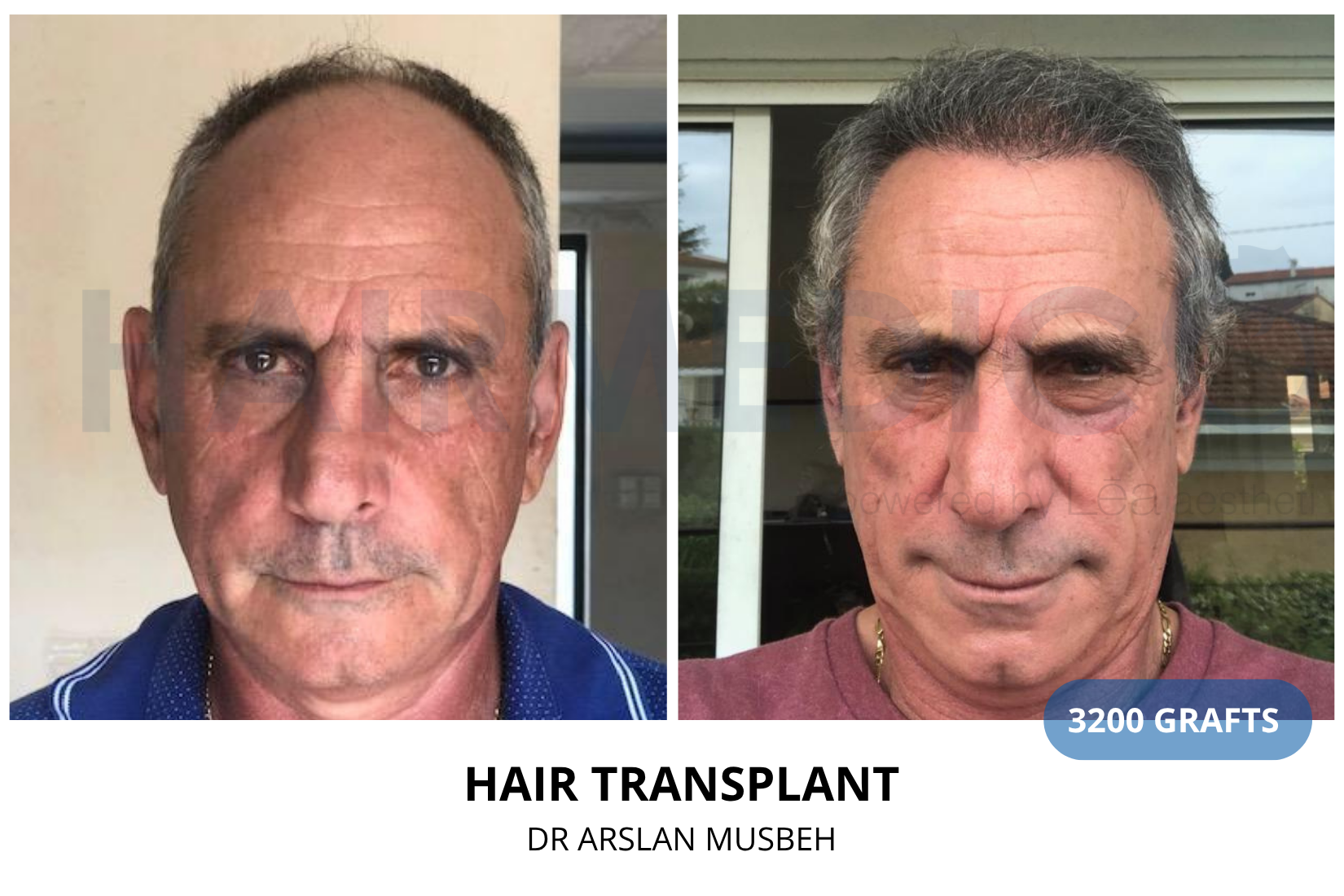 Hair Transplant result, 3200 grafts by Dr. Arslan Musbeh