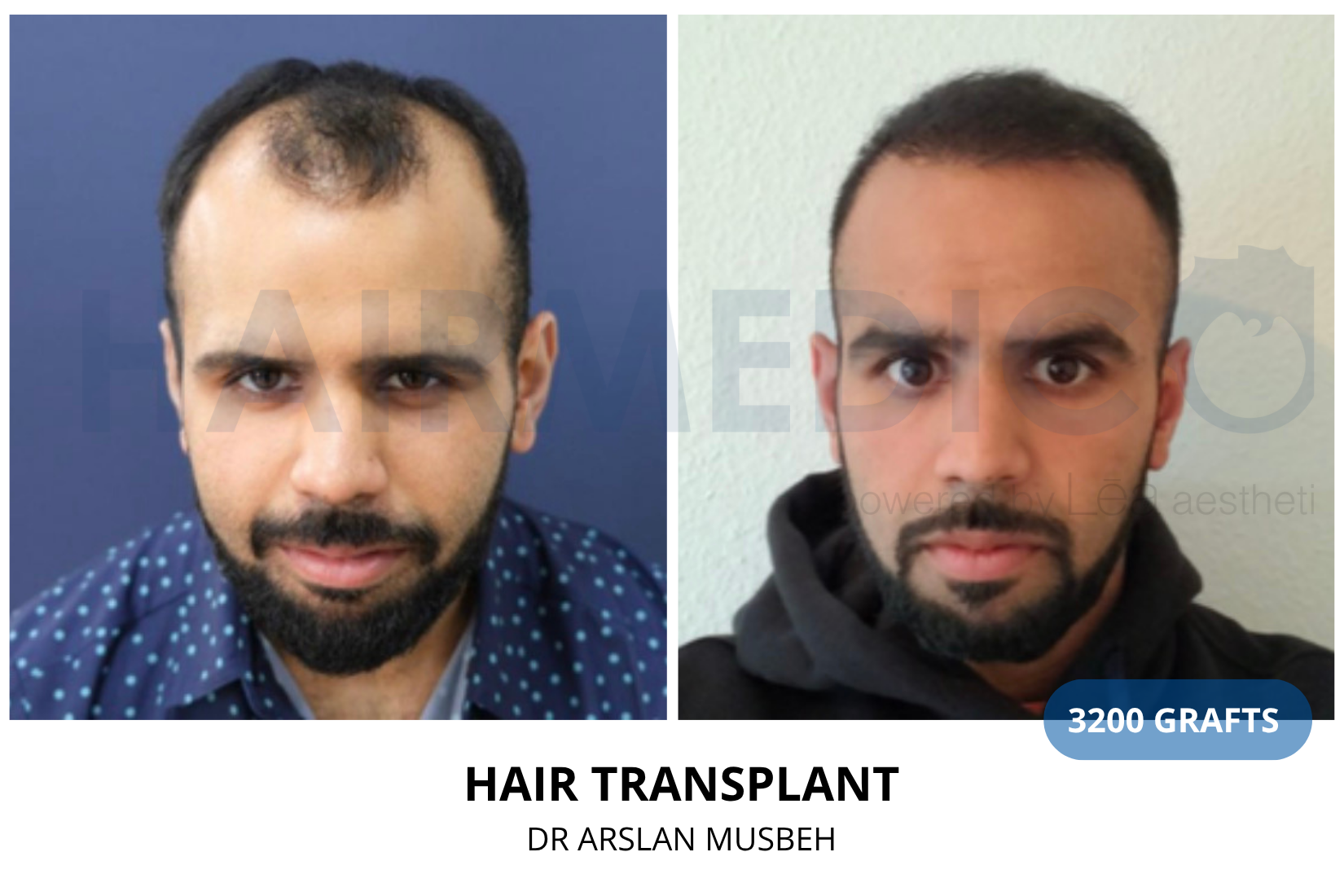 Hair Transplant result, 3200 grafts by Dr. Arslan Musbeh