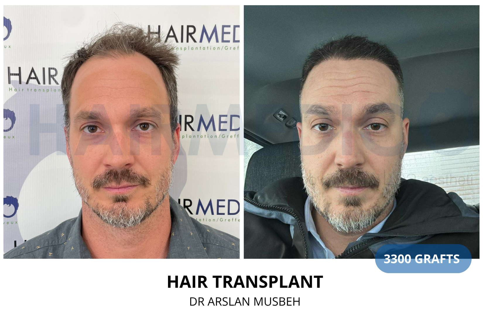 Hair Transplant result, 3300 grafts by Dr. Arslan Musbeh