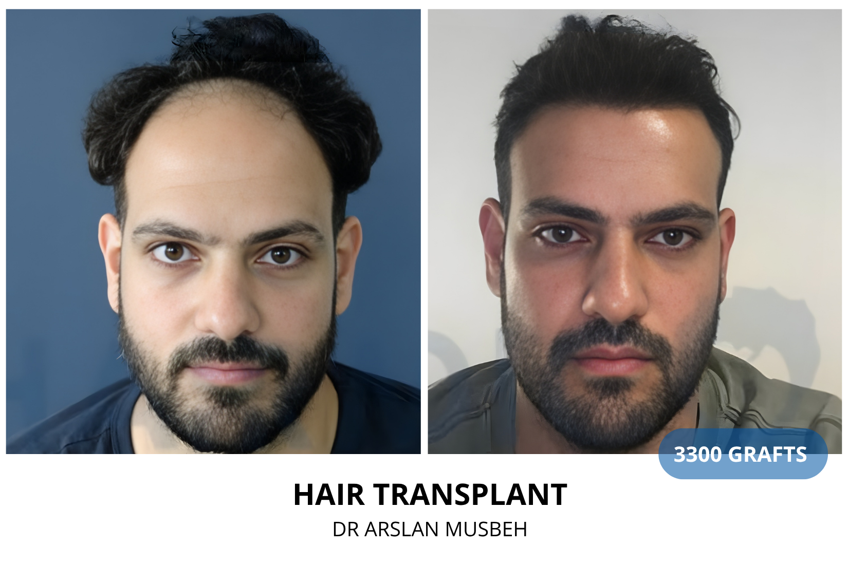 Hair Transplant result, 3300 grafts by Dr. Arslan Musbeh