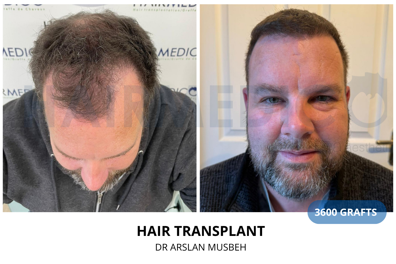 Hair Transplant result, 3600 grafts by Dr. Arslan Musbeh