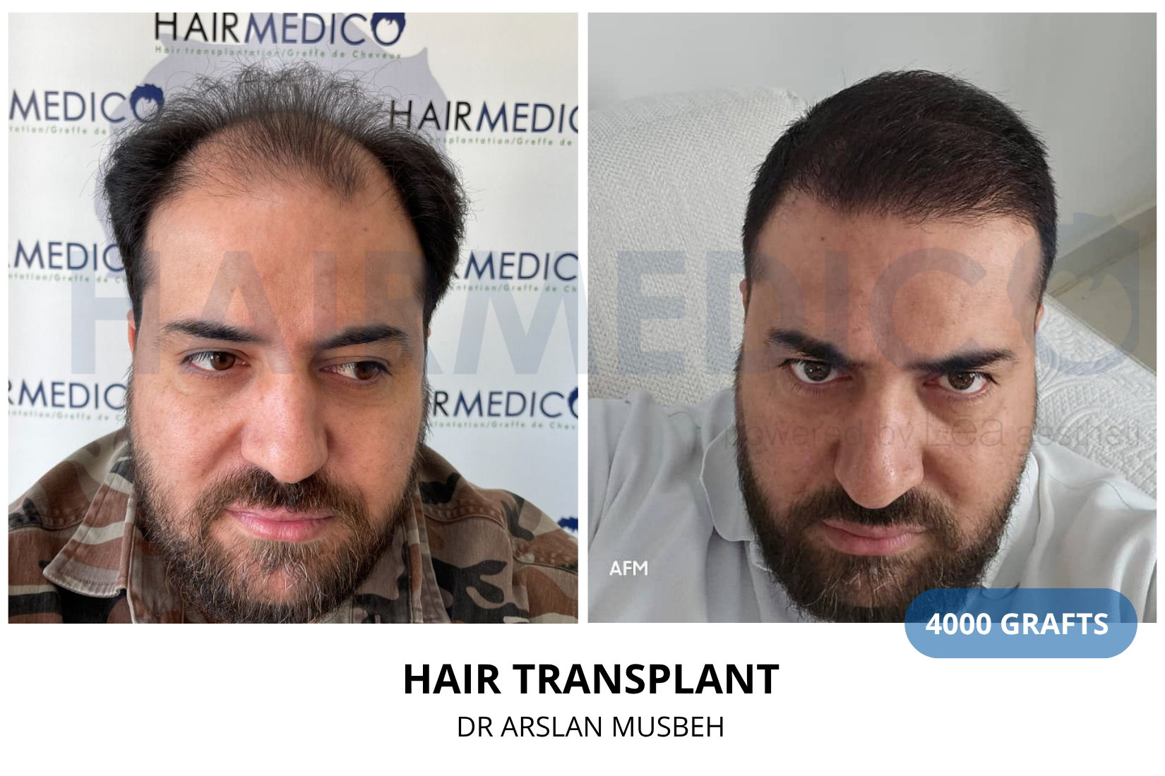 Hair Transplant result, 4000 grafts by Dr. Arslan Musbeh