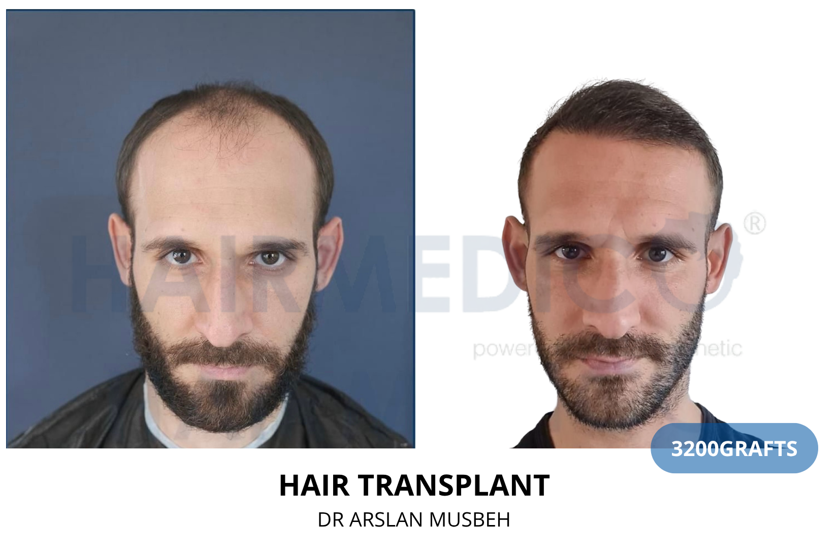 Hair Transplant result, 3200 grafts by Dr. Arslan Musbeh