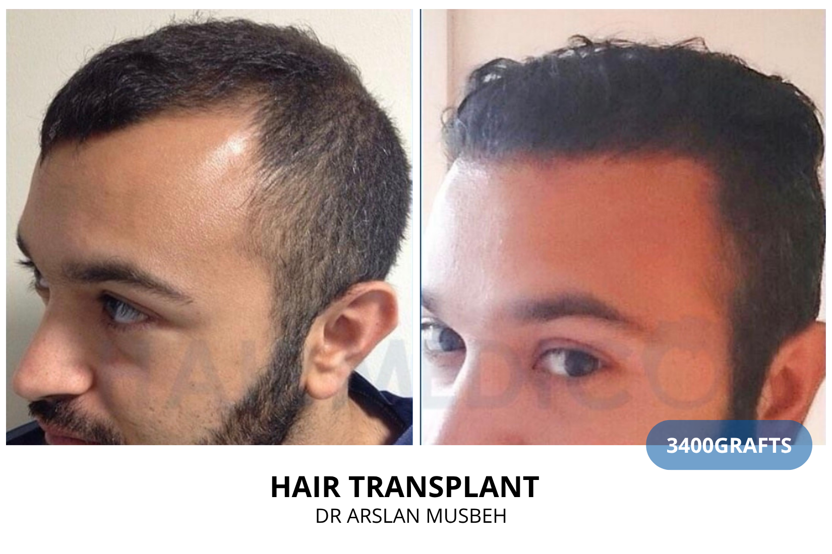 Hair Transplant result, 3400 grafts by Dr. Arslan Musbeh