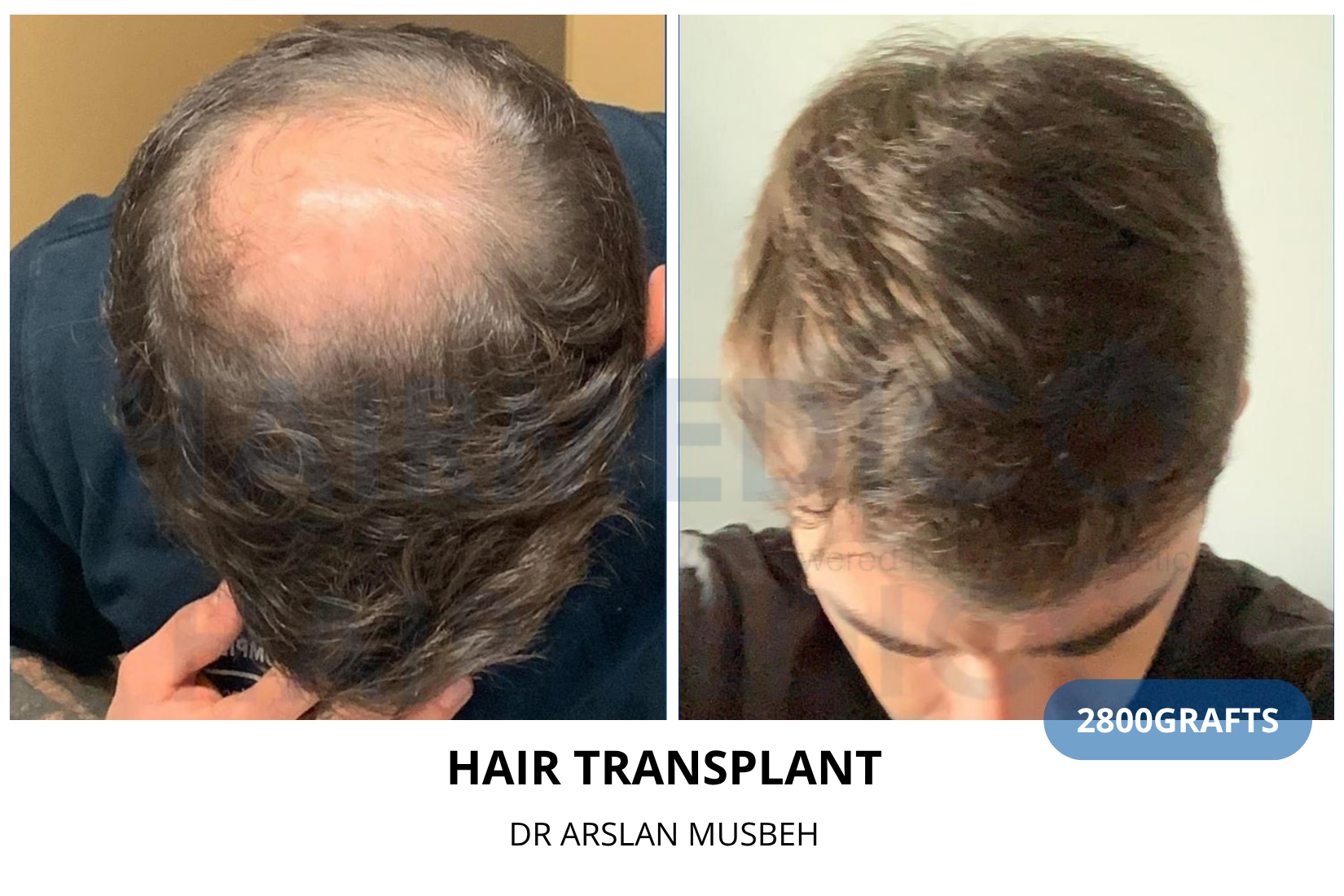 Hair Transplant result, 2800 grafts by Dr. Arslan Musbeh