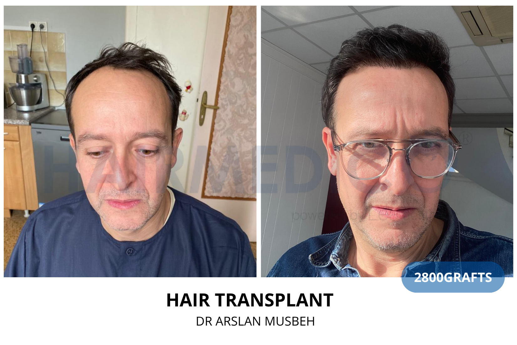 Hair Transplant result, 2800 grafts by Dr. Arslan Musbeh