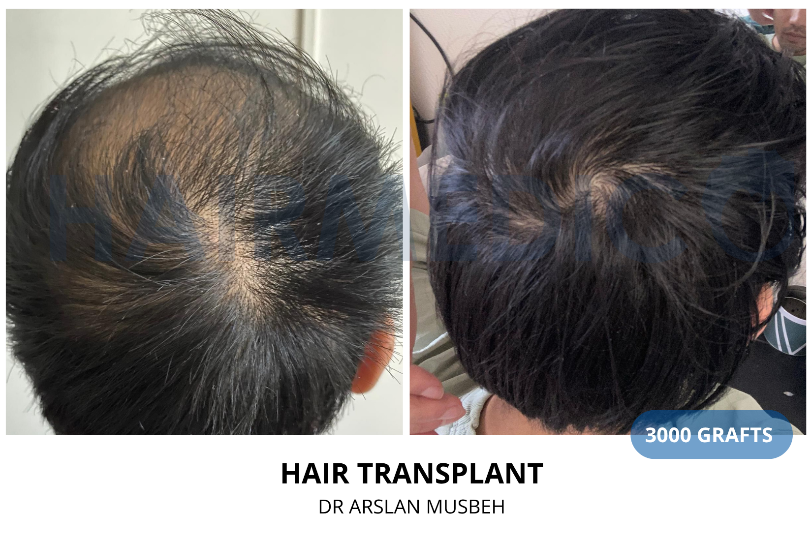 Hair Transplant result, 3000 grafts by Dr. Arslan Musbeh