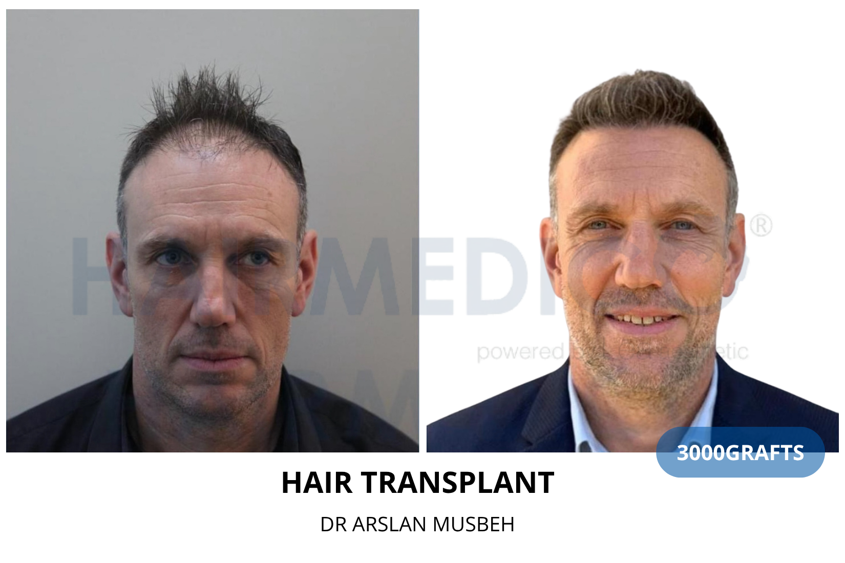 Hair Transplant result, 3000 grafts by Dr. Arslan Musbeh