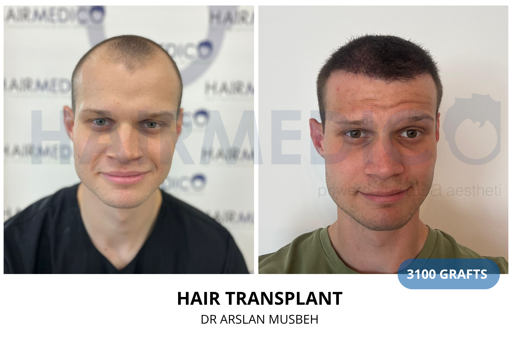 Hair Transplant result, 3100 grafts by Dr. Arslan Musbeh