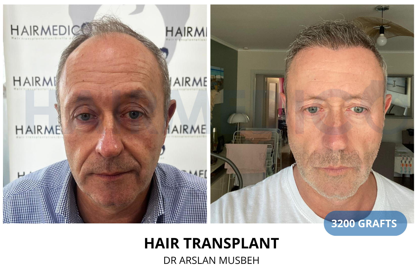 Hair Transplant result, 3200 grafts by Dr. Arslan Musbeh