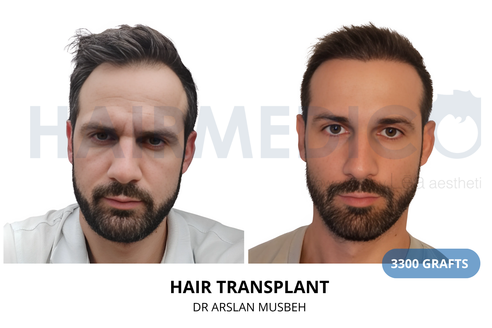 Hair Transplant result, 3300 grafts by Dr. Arslan Musbeh