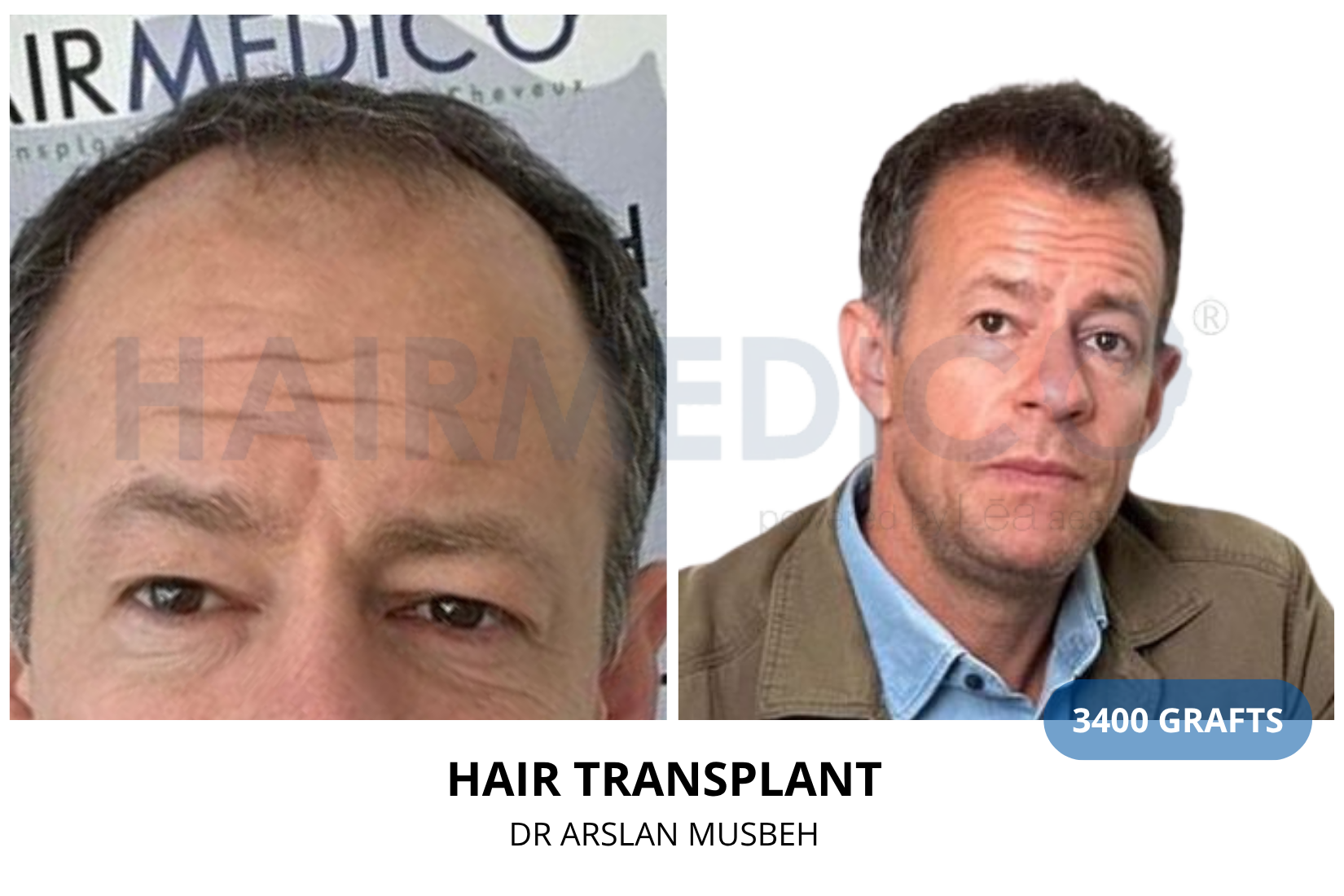 Hair Transplant result, 3400 grafts by Dr. Arslan Musbeh
