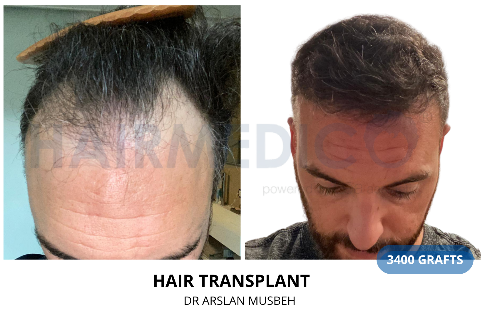 Hair Transplant result, 3400 grafts by Dr. Arslan Musbeh
