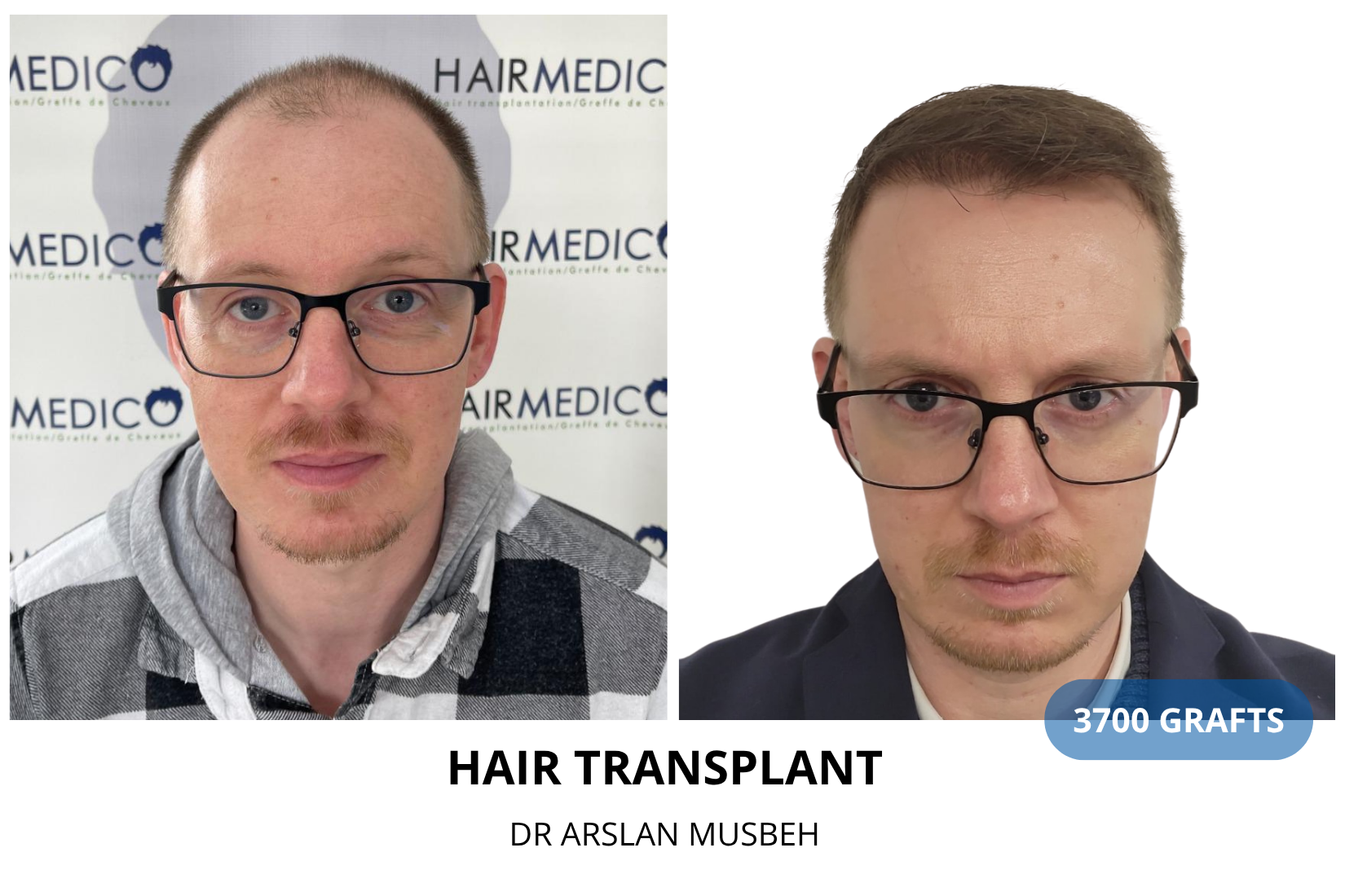 Hair Transplant result, 3700 grafts by Dr. Arslan Musbeh