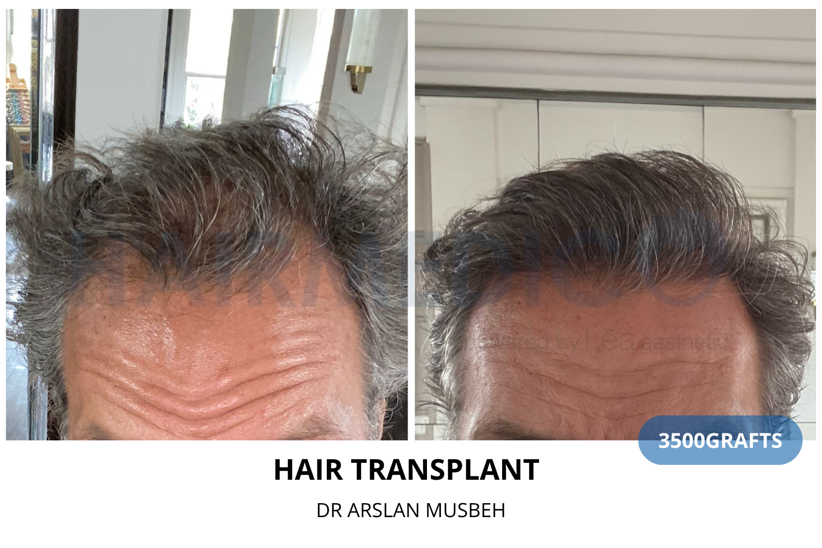 DHI Hair Transplant - DHI result, 3500 grafts by Dr. Arslan Musbeh