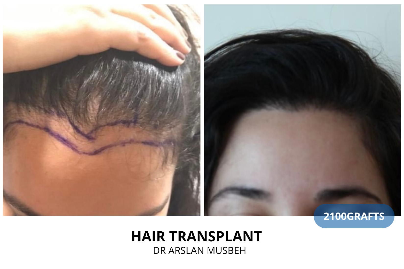 Women Hair Transplant result, 2100 grafts by Dr. Arslan Musbeh