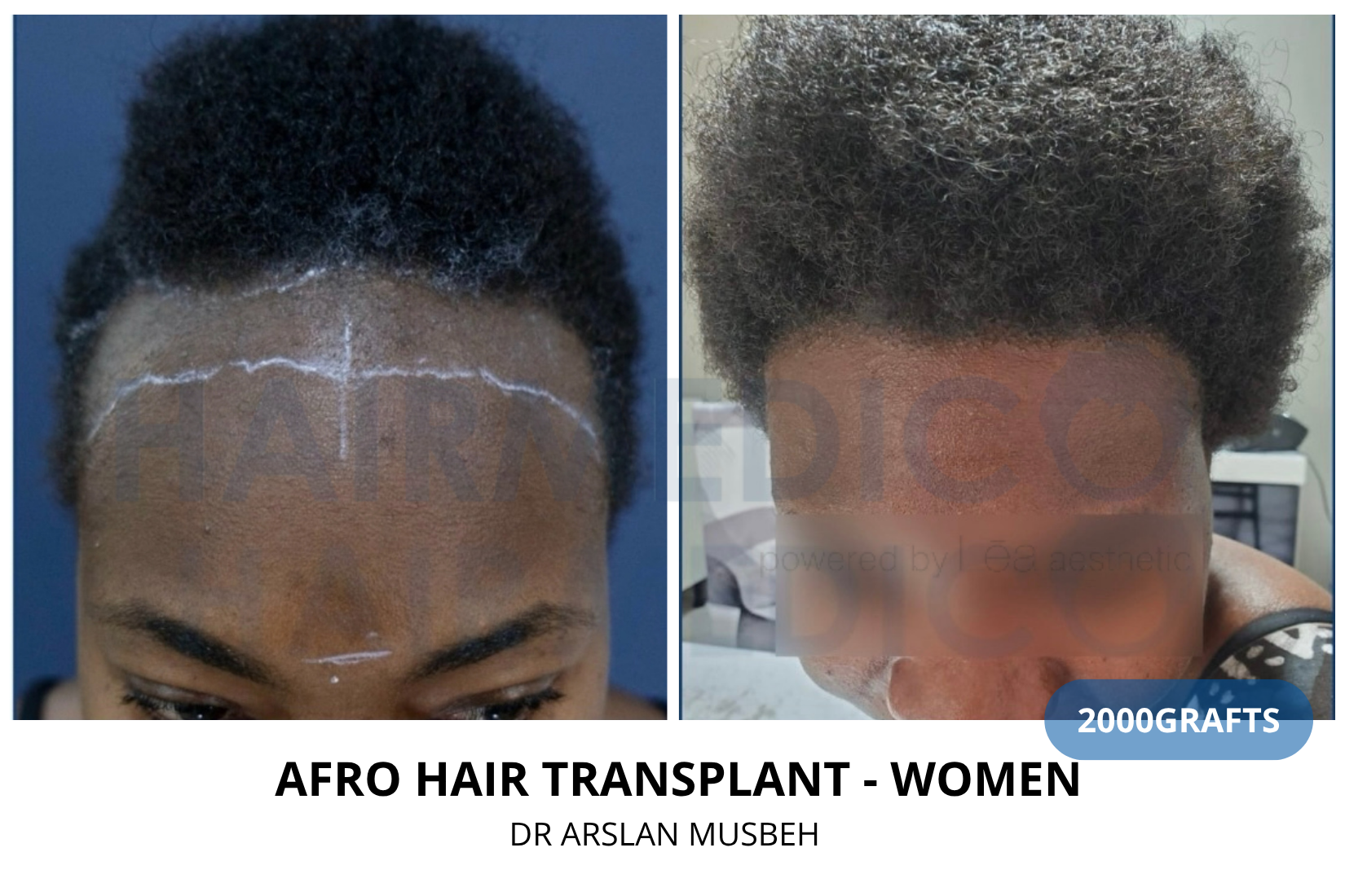 Women Hair Transplant result, 2000 grafts by Dr. Arslan Musbeh