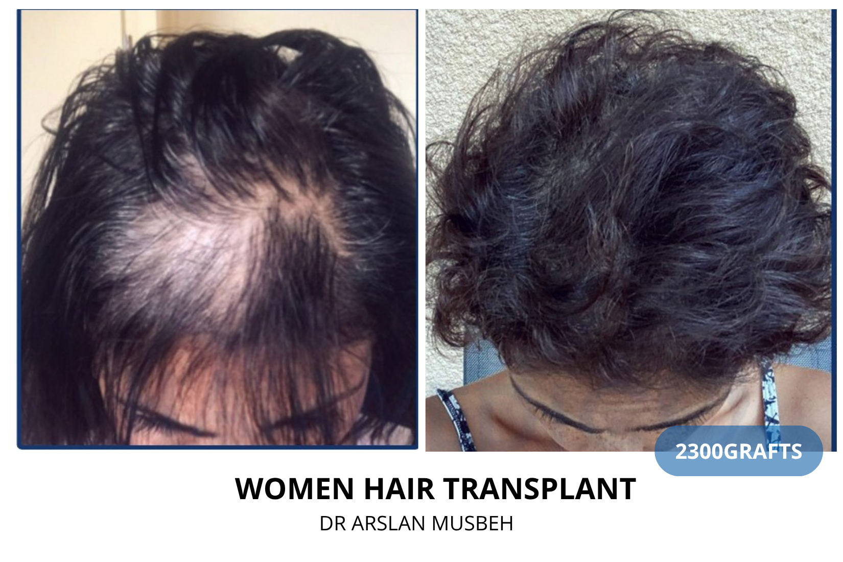Women Hair Transplant - DHI result, 2300 grafts by Dr. Arslan Musbeh