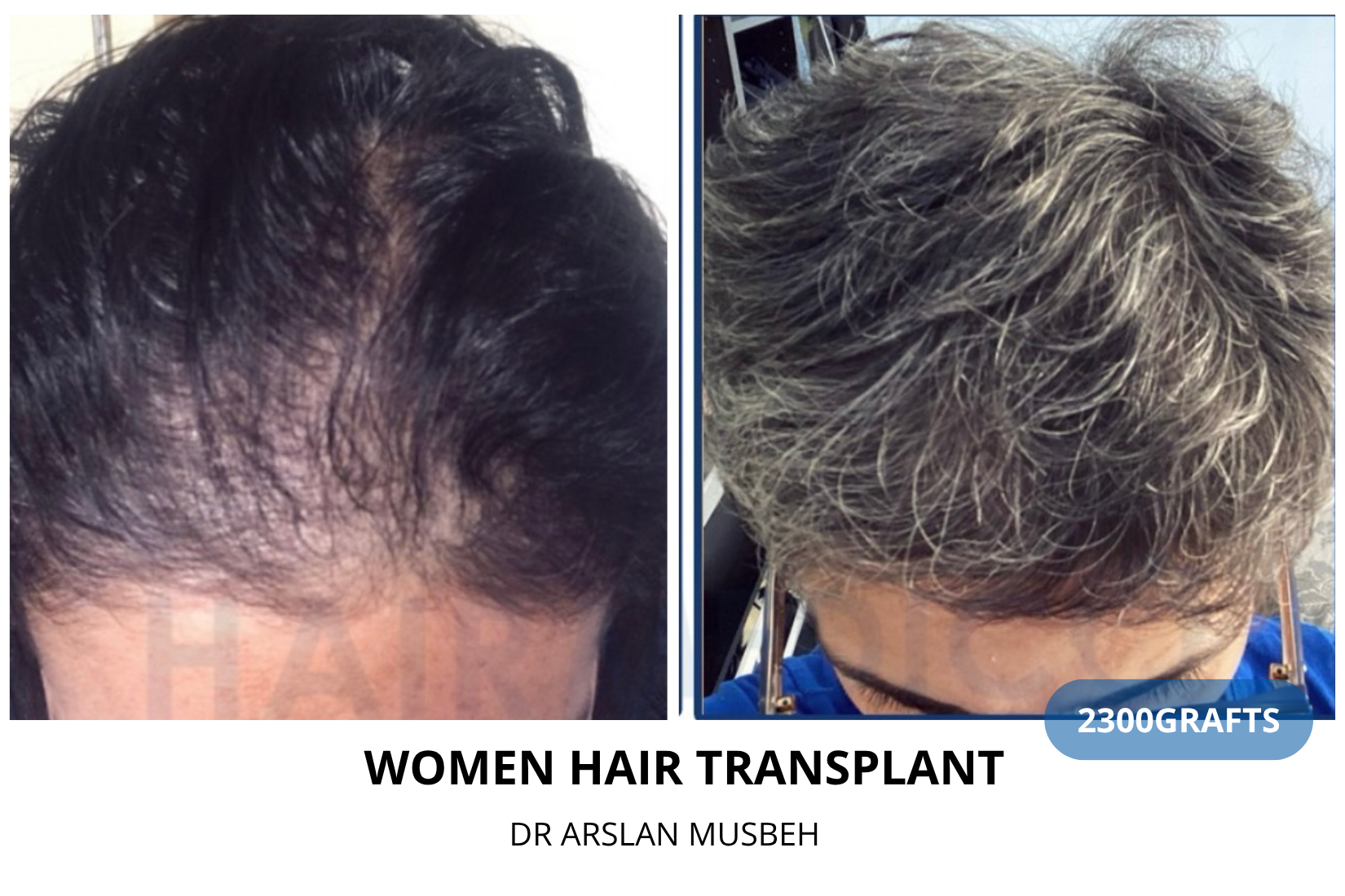 Women Hair Transplant - DHI result, 2300 grafts by Dr. Arslan Musbeh
