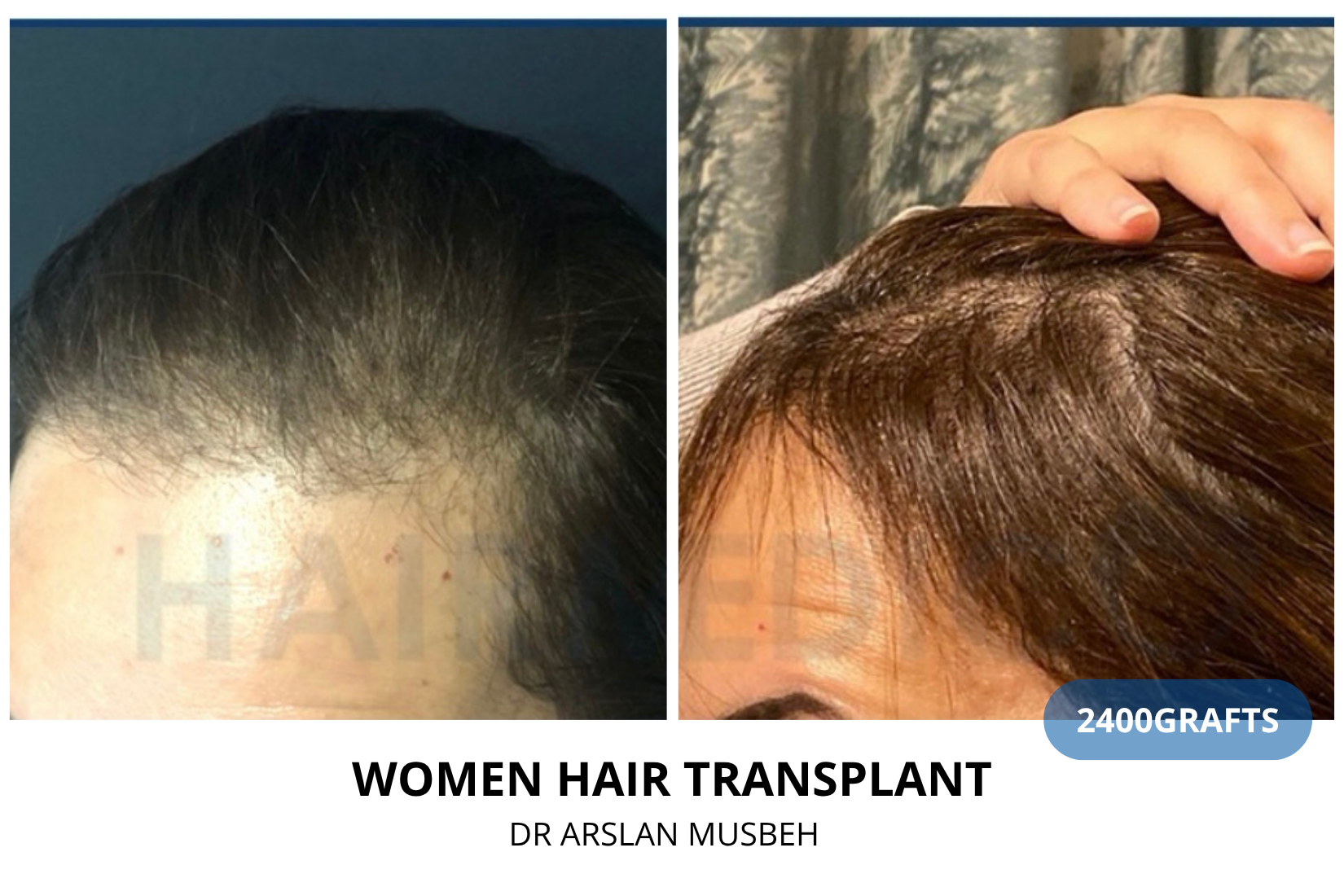 Women Hair Transplant - DHI result, 2400 grafts by Dr. Arslan Musbeh