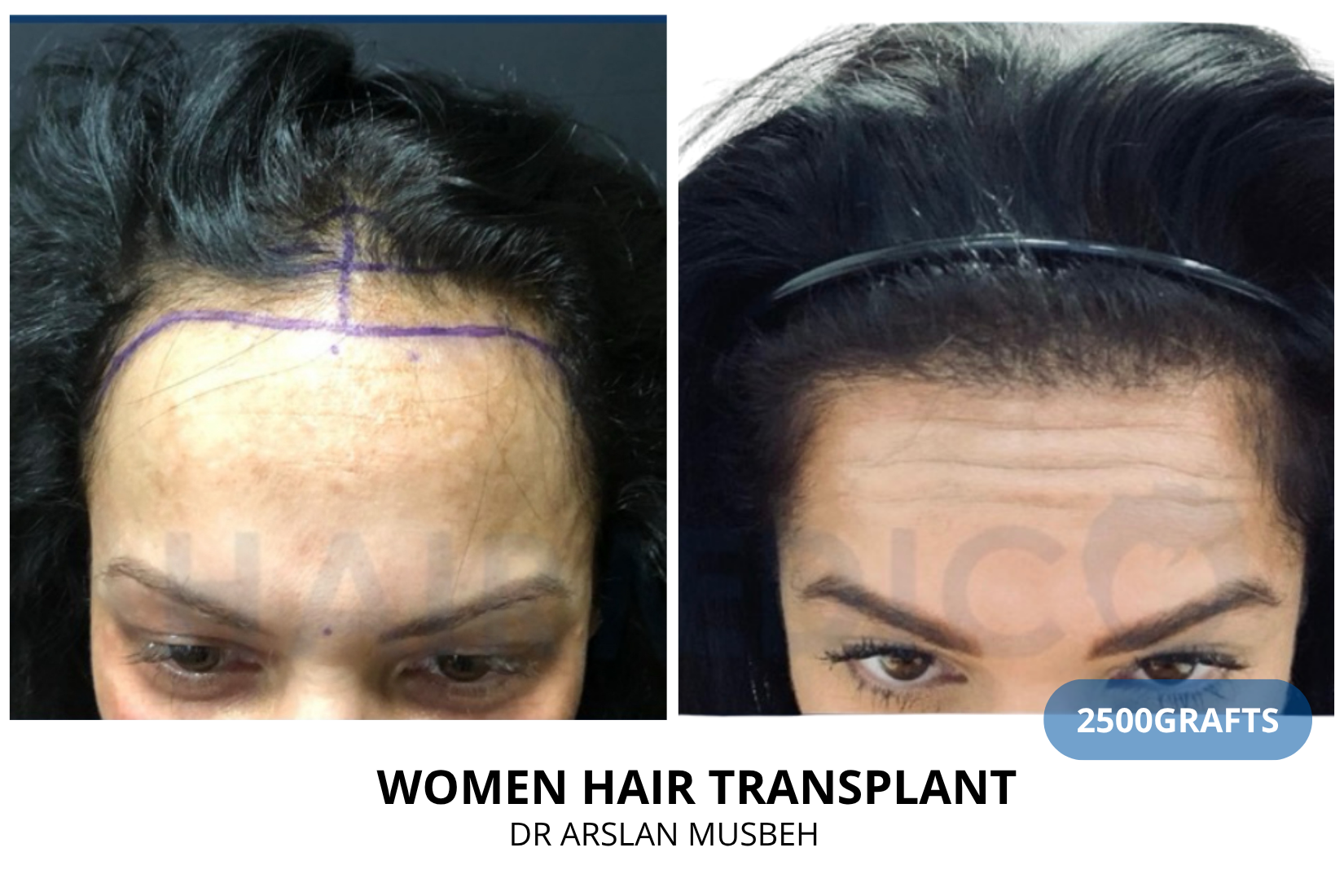 Women Hair Transplant - DHI result, 2500 grafts by Dr. Arslan Musbeh