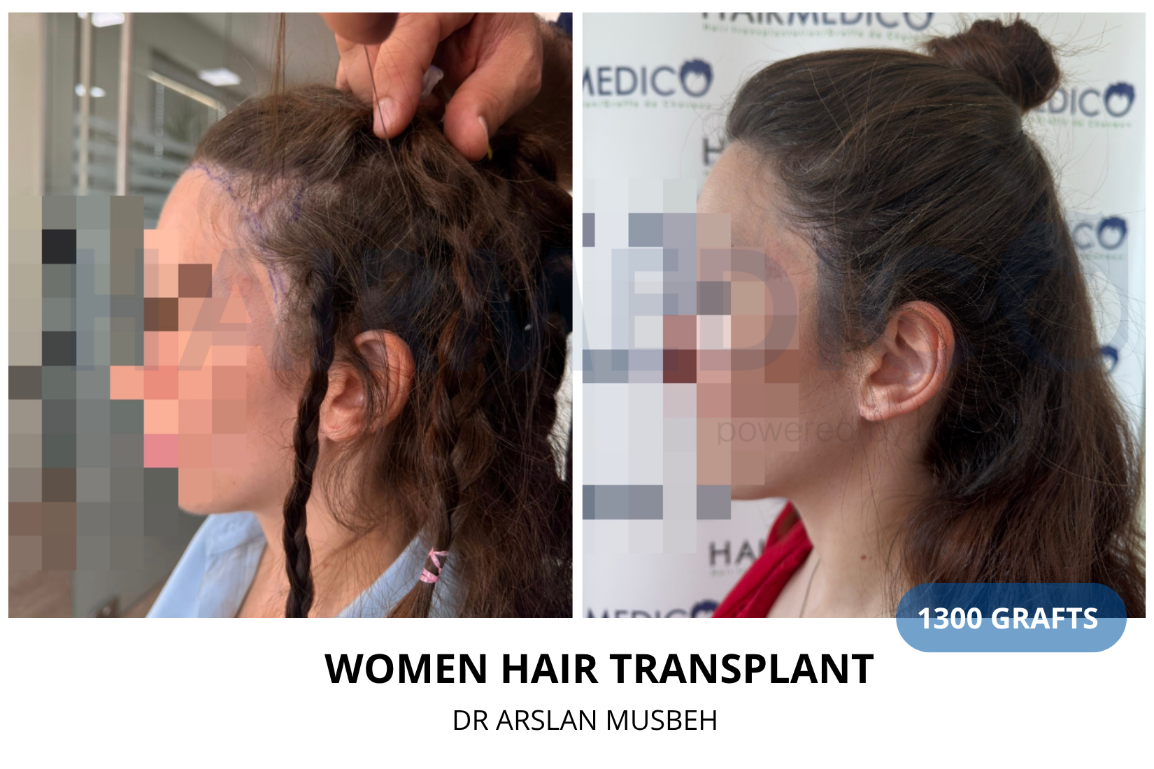 Women Hair Transplant - DHI result, 1300 grafts by Dr. Arslan Musbeh