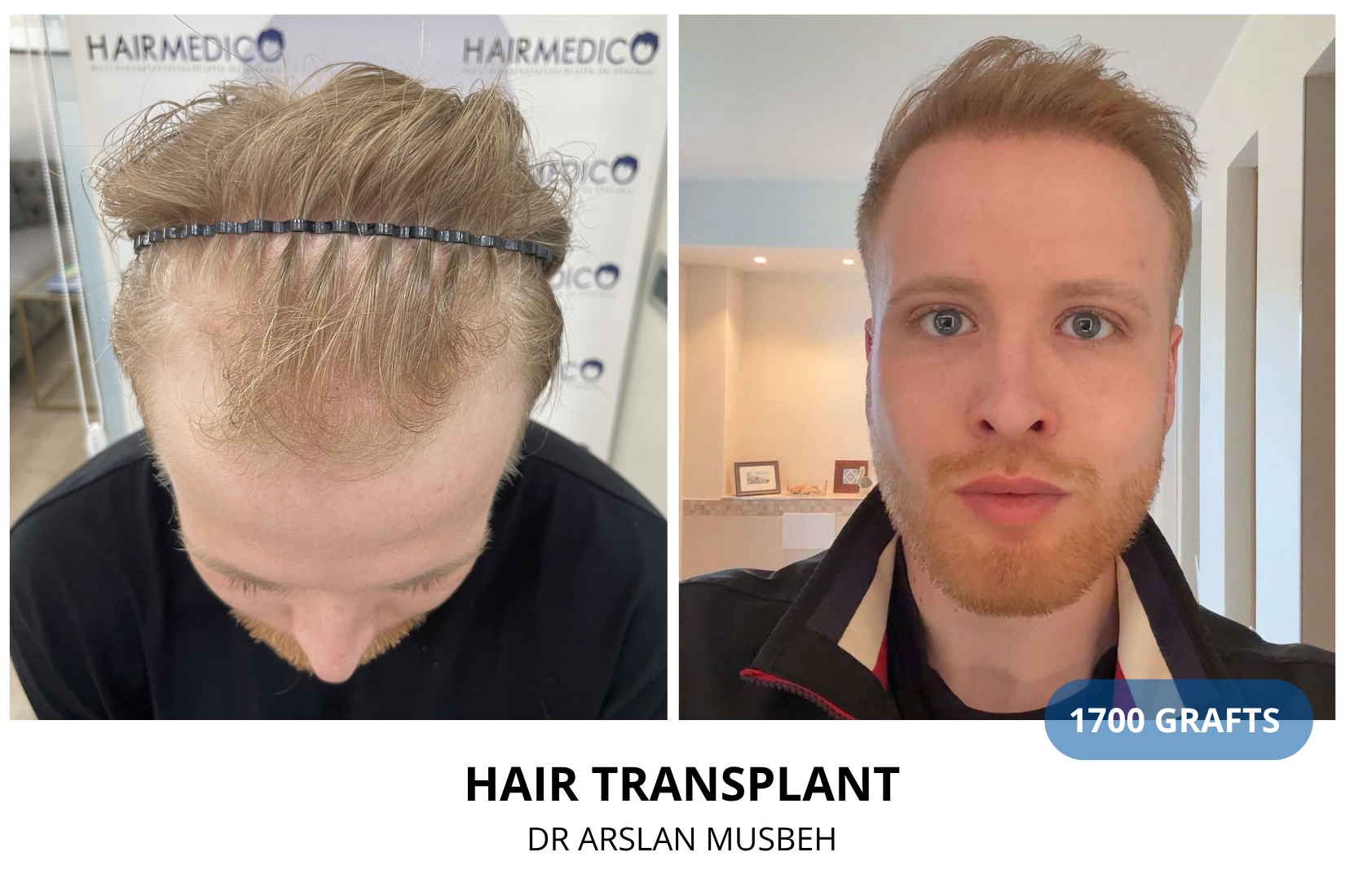 Hair Transplant result, 1700 grafts by Dr. Arslan Musbeh