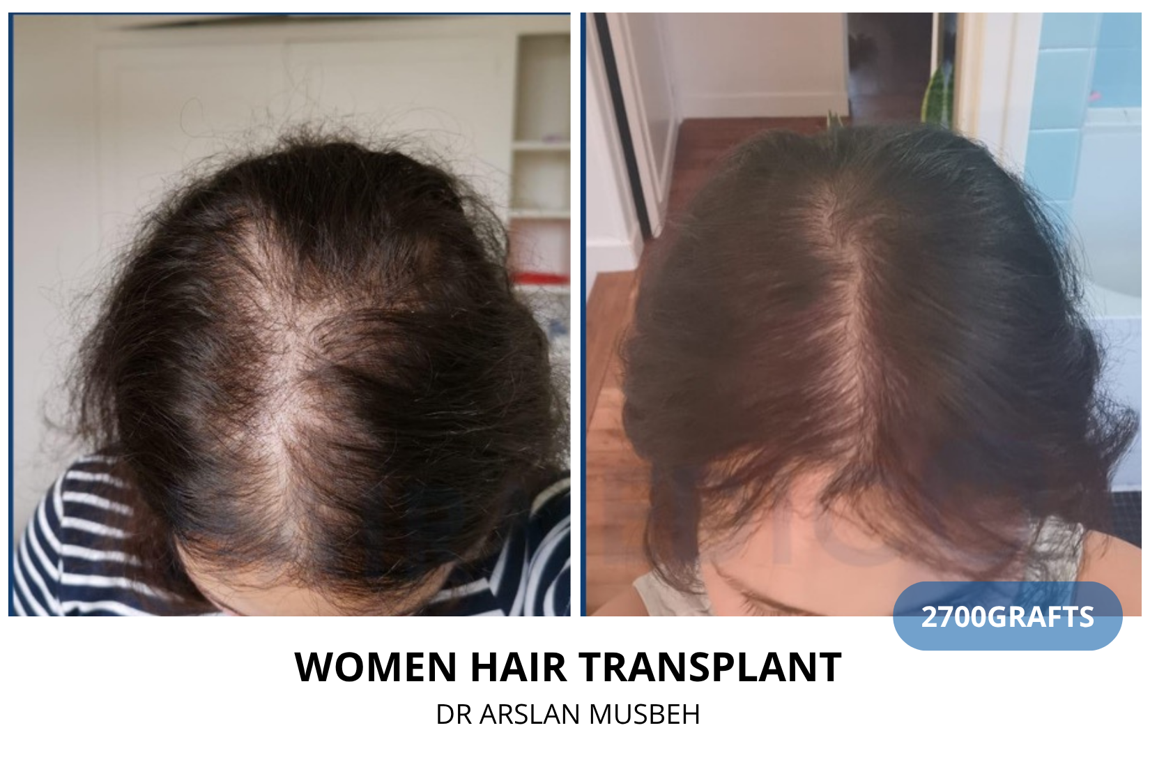Women DHI Hair Transplant result, 2700 grafts by Dr. Arslan Musbeh