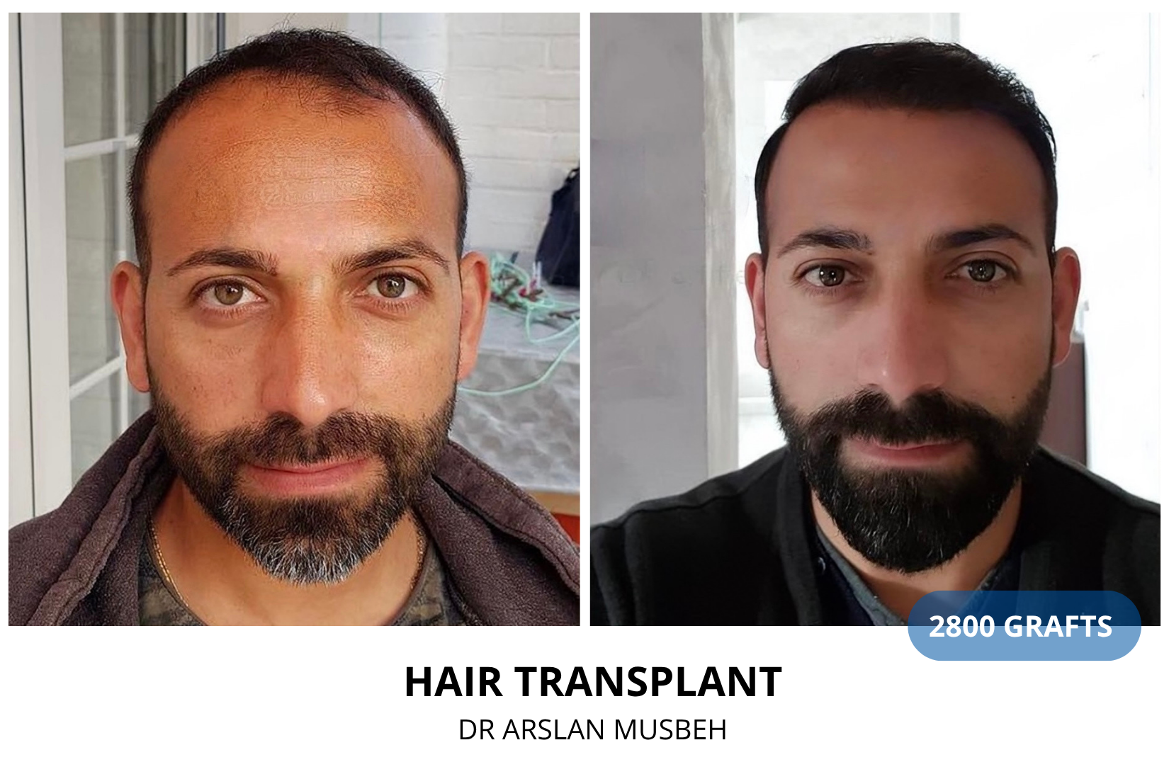 Hair Transplant result, 2800 grafts by Dr. Arslan Musbeh