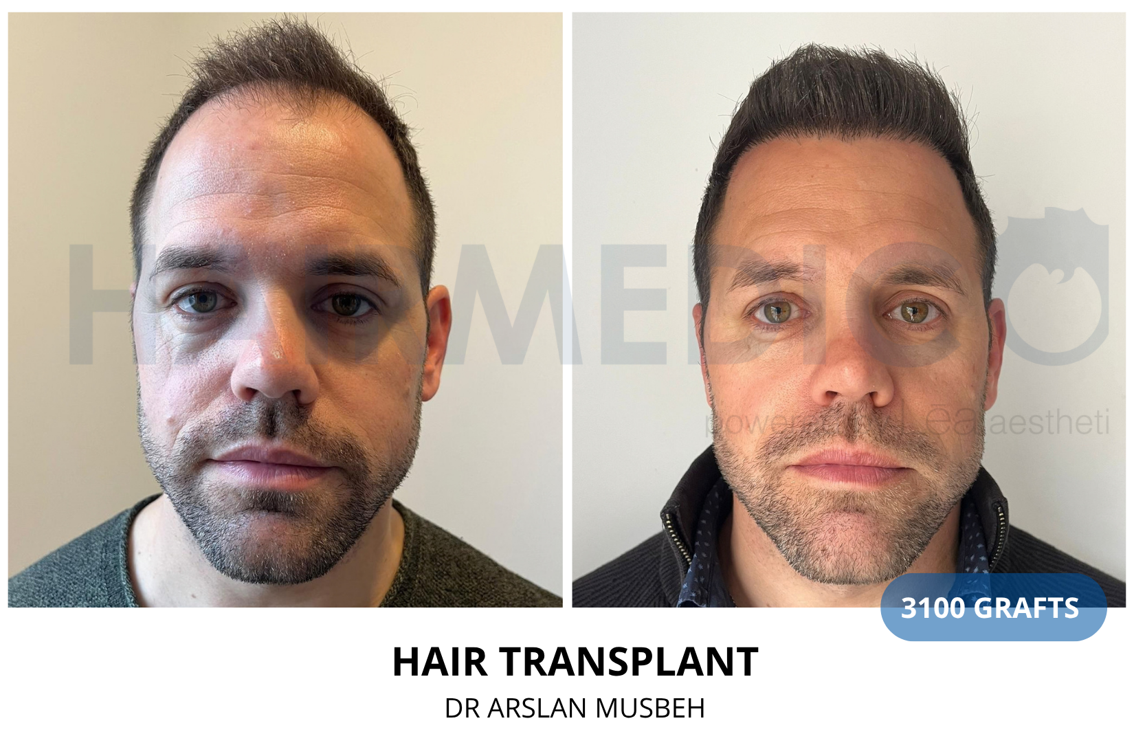 Hair Transplant result, 3100 grafts by Dr. Arslan Musbeh
